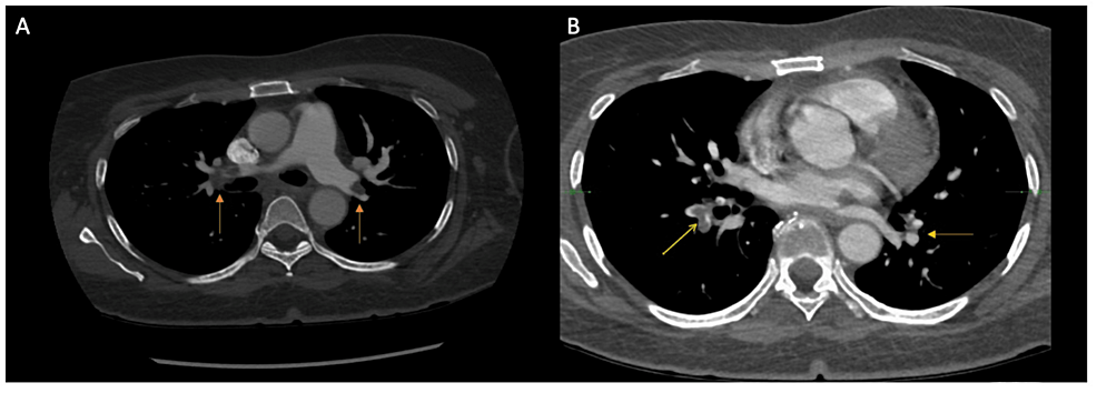 Cureus | Thrombotic Storm Induced by Rituximab in a Patient With ...