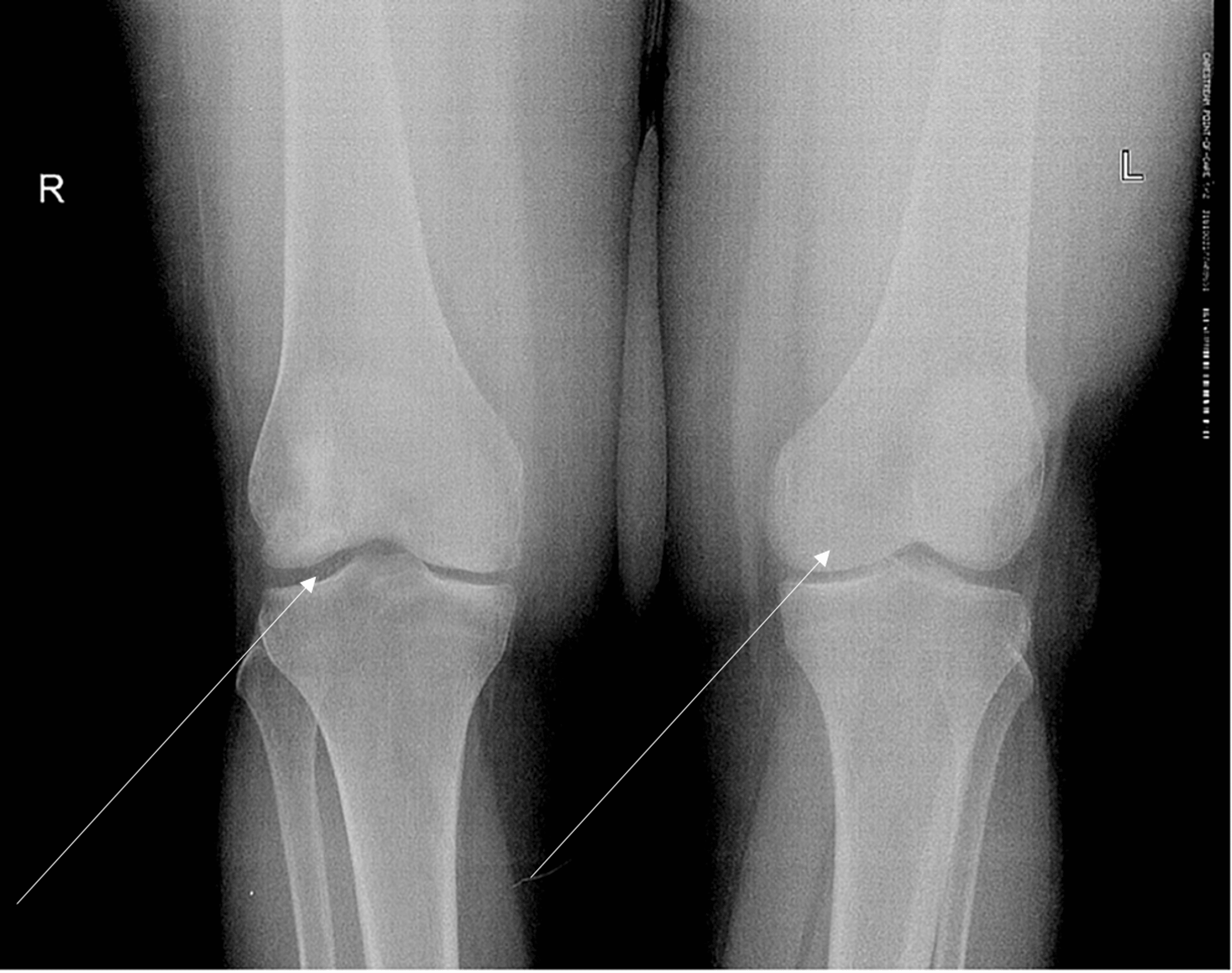 Avascular Necrosis as a Sequela of COVID19 A Case Series Cureus