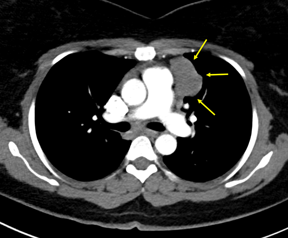 Cureus Thymoma and Myasthenia Gravis An Examination of a