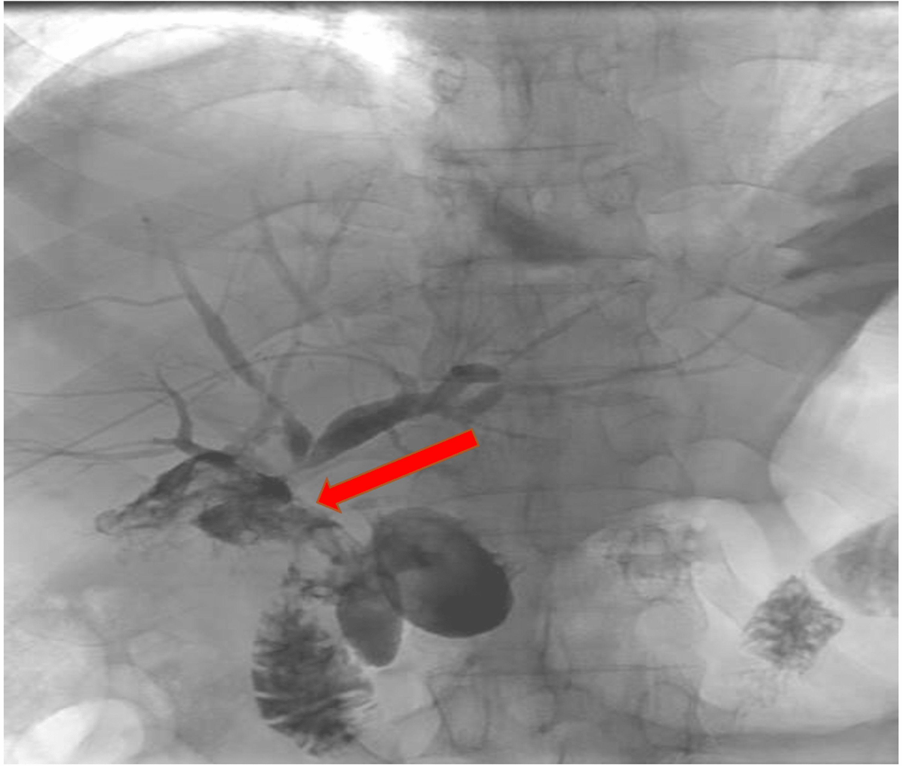 Cureus Percutaneous Management of Hepatic Duct Injury Using Extra