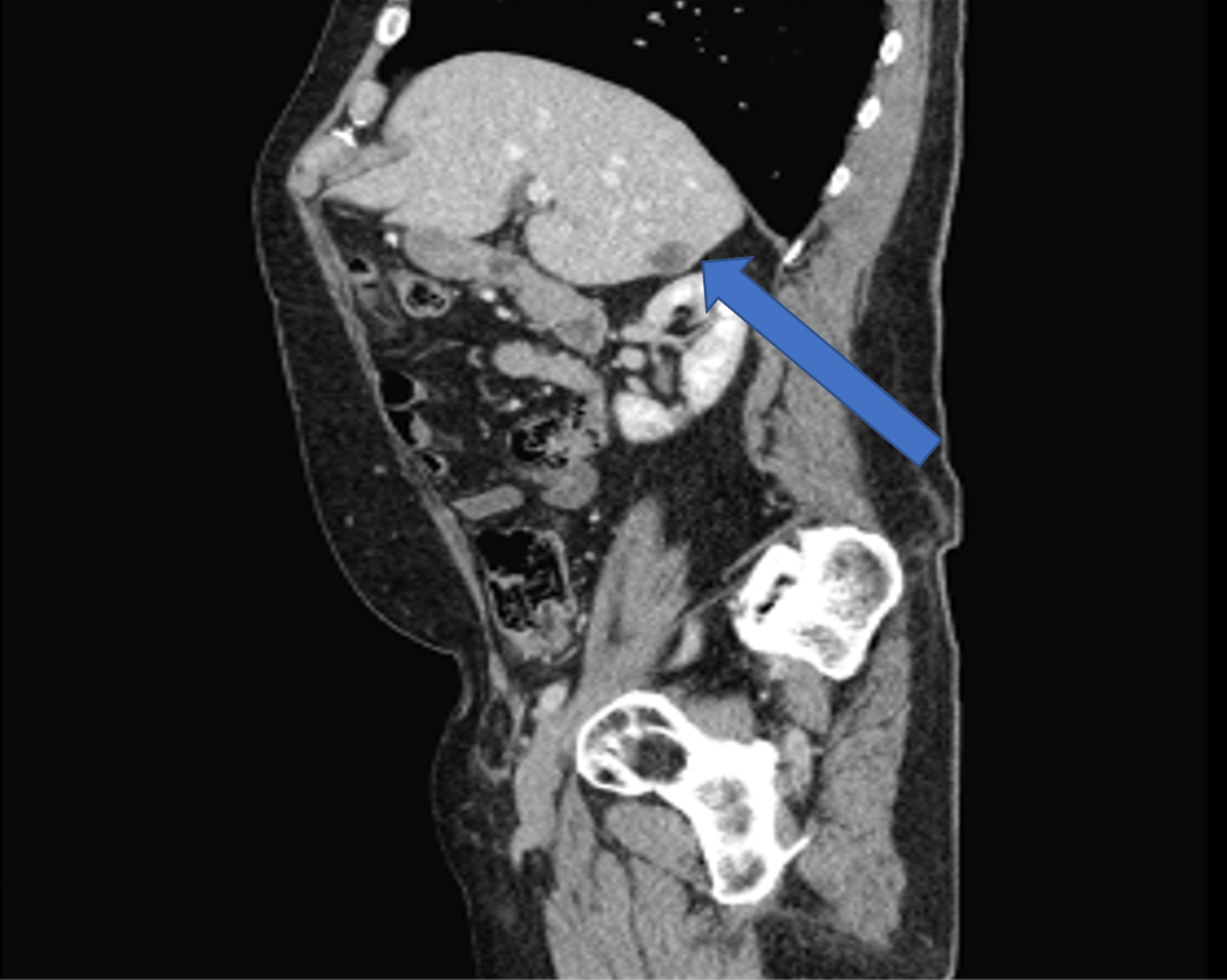 Cureus | Intraductal Papillary Neoplasm of the Bile Duct: A Rare