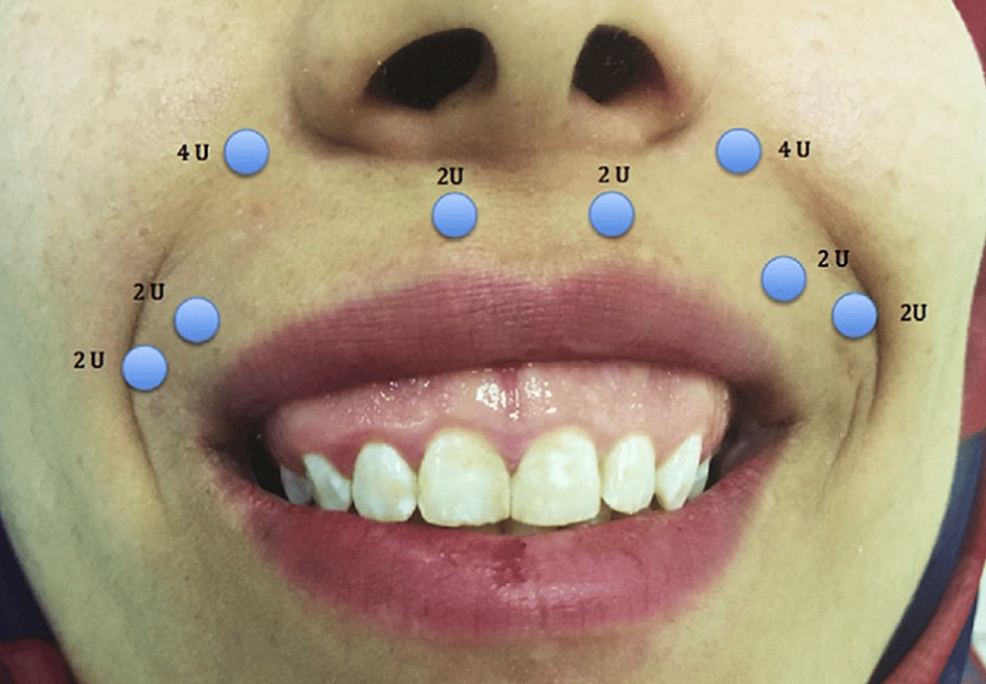 Injection-sites-of-20-units-of-Botox.