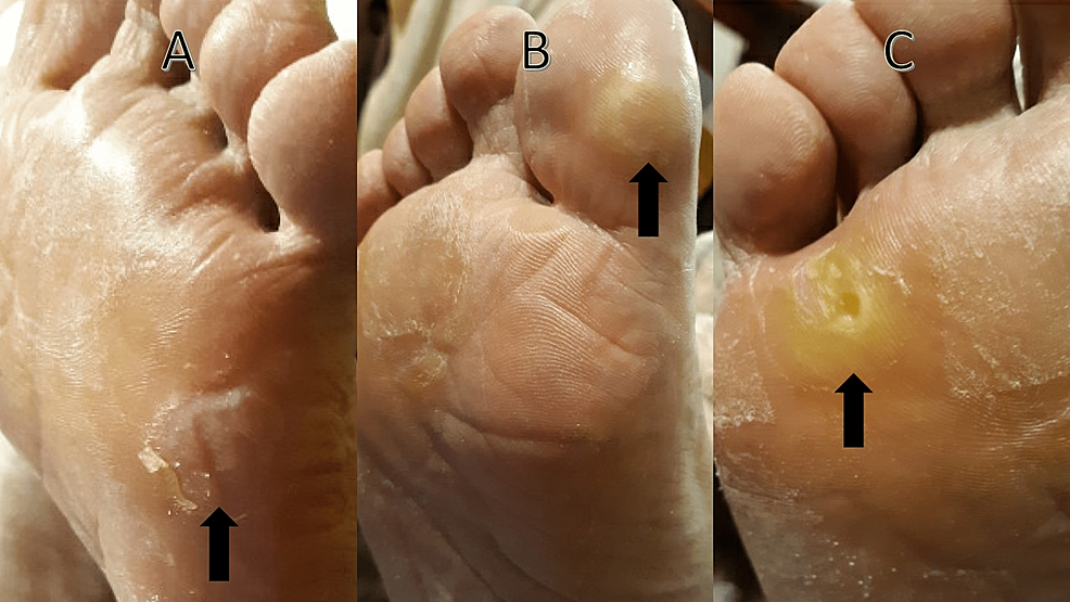 Cureus Painful Foot Lesions A Case Report