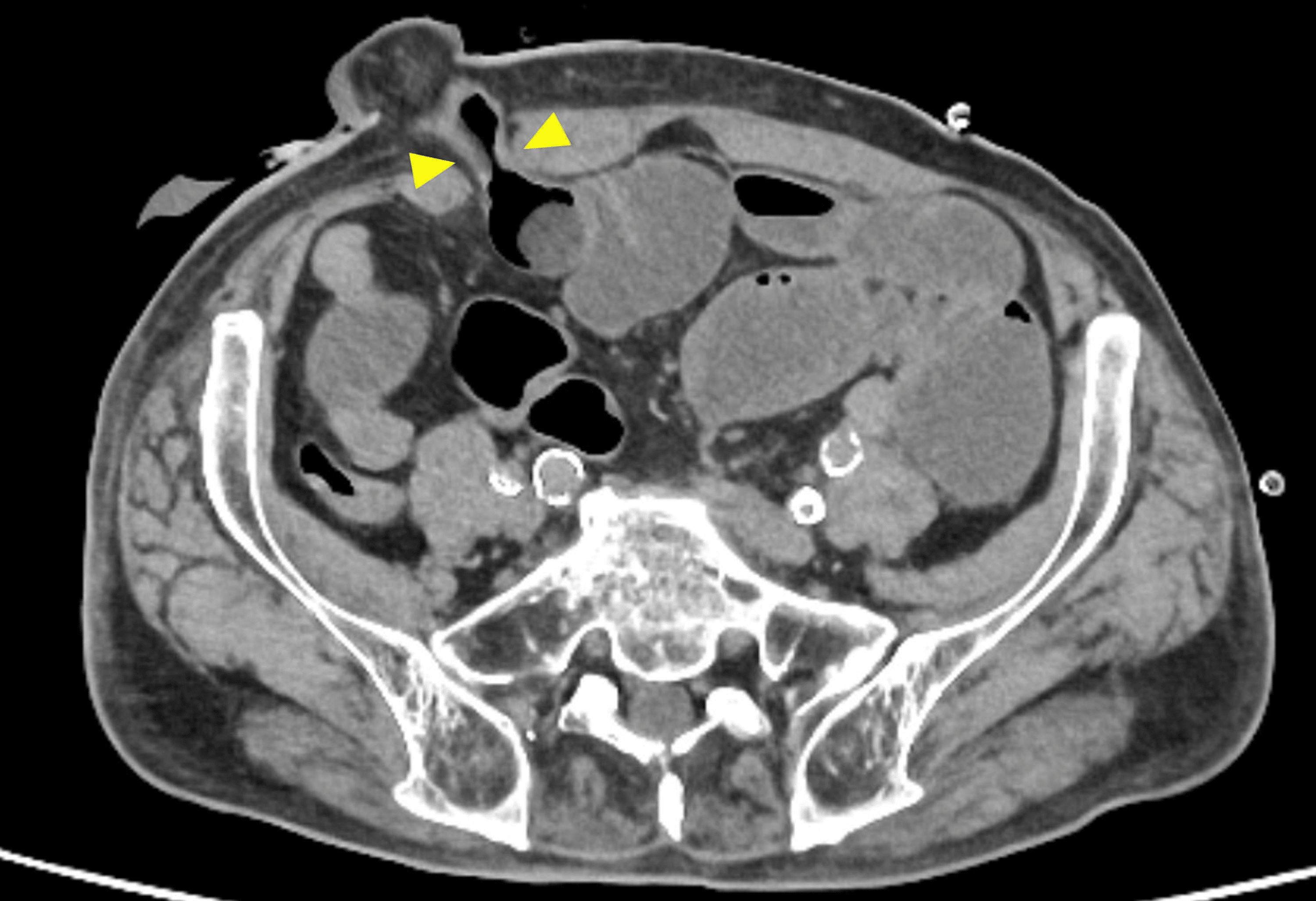 Cureus | Diagnosis, Treatment, and Prevention of Ileostomy ...