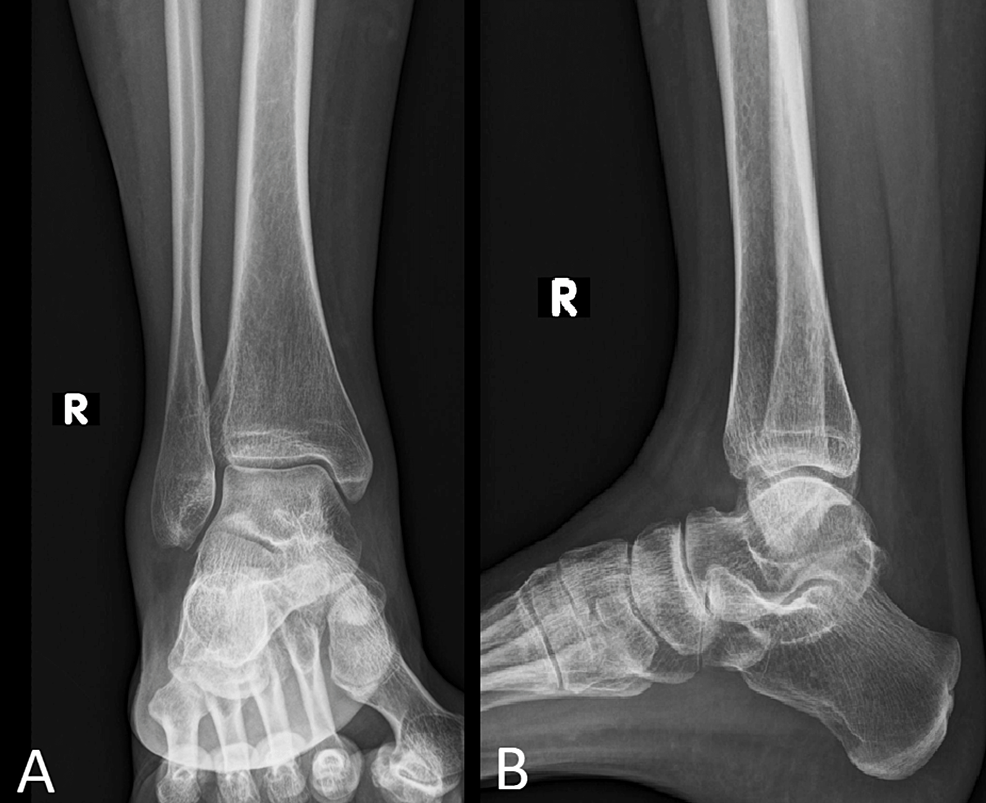 Malunited fracture - tibia, Radiology Case