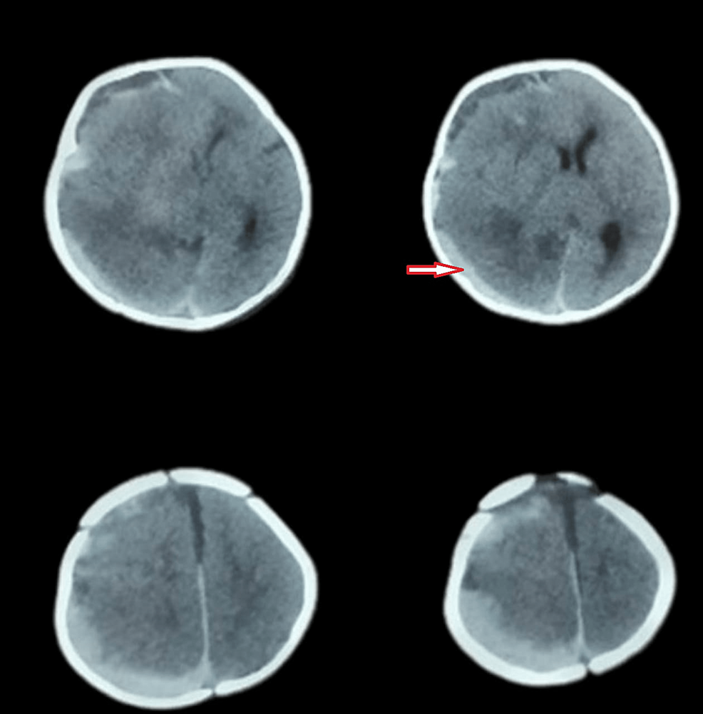 AcuteonChronic Subdural Hemorrhage Due to Late Vitamin K Deficiency