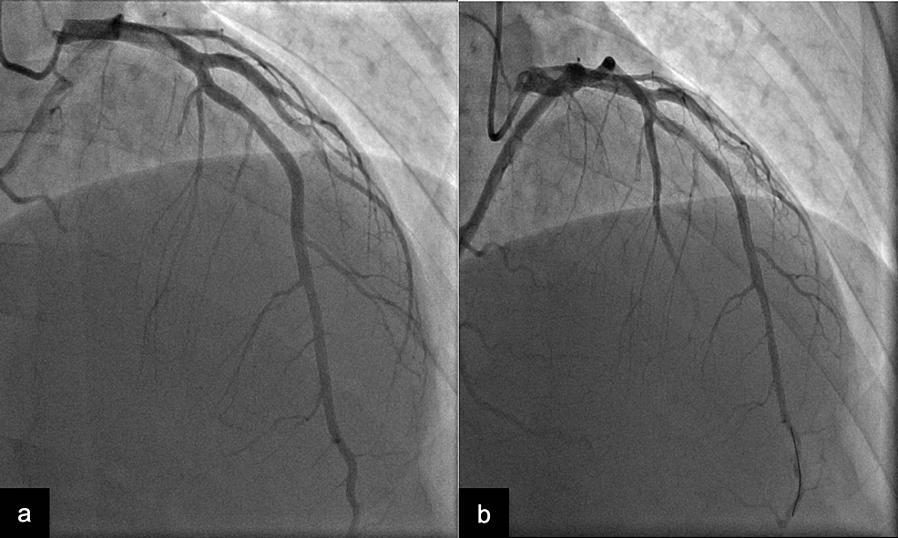 Myocardial Infarction Due to Paradoxical Thromboembolism Originating ...