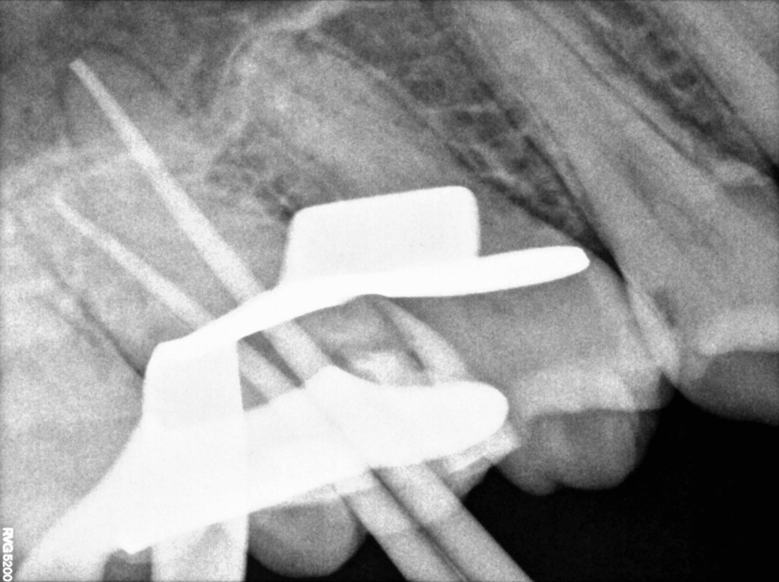 Cureus | Cone-Beam Computed Tomography (CBCT) Analysis of an Unusual 