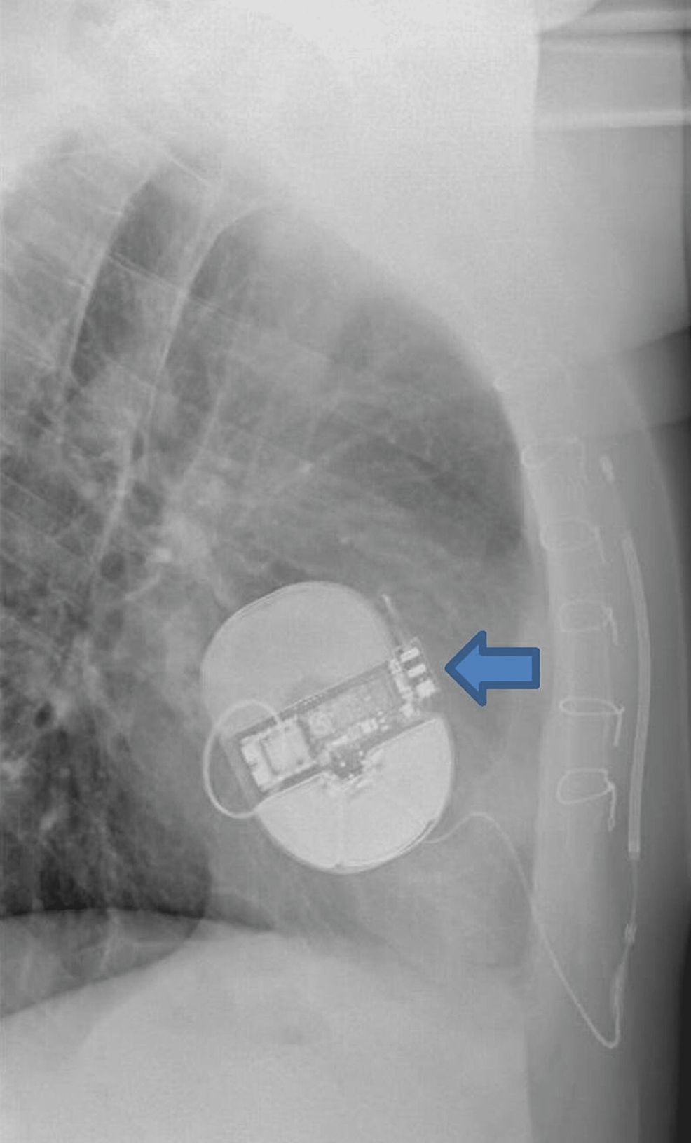 Inappropriate Shocks With Subcutaneous Implantable Cardioverter