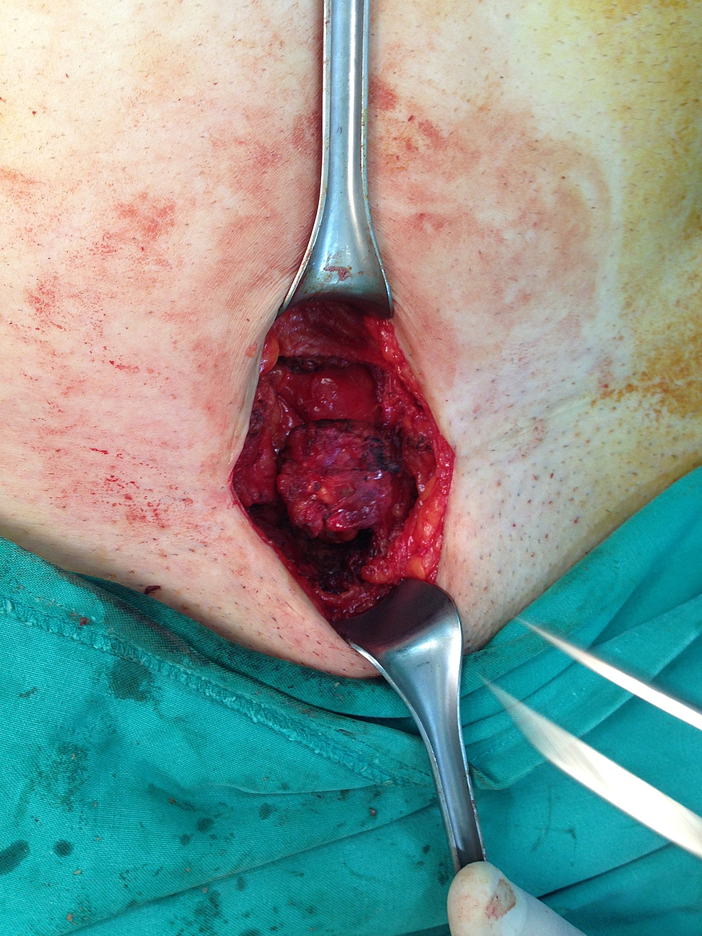 Intraoperative-image-showing-the-endometrioma-in-the-subcutaneous-tissue-of-the-abdominal-wall.
