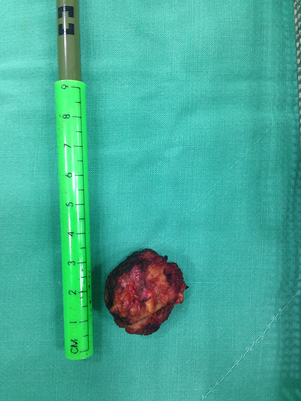 Image-showing-the-resected-endometrioma-next-to-a-graded-ruler.
