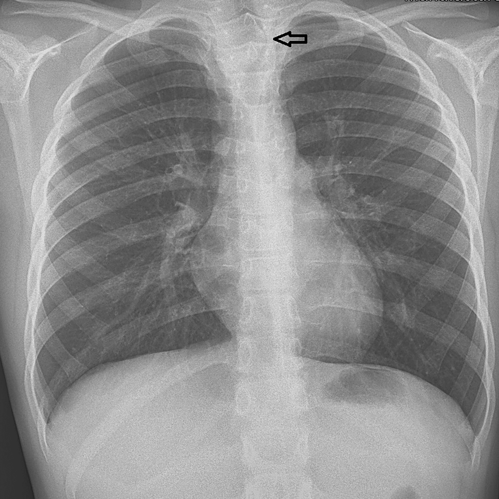 cureus-mediastinal-myofibroblastic-inflammatory-tumor-compressing-the