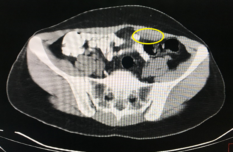 Computed-tomography-scan-showing-the-endometrioma-(yellow-circle)-contained-in-the-rectus-muscle,-marked-by-a-hypodensity-lesion.