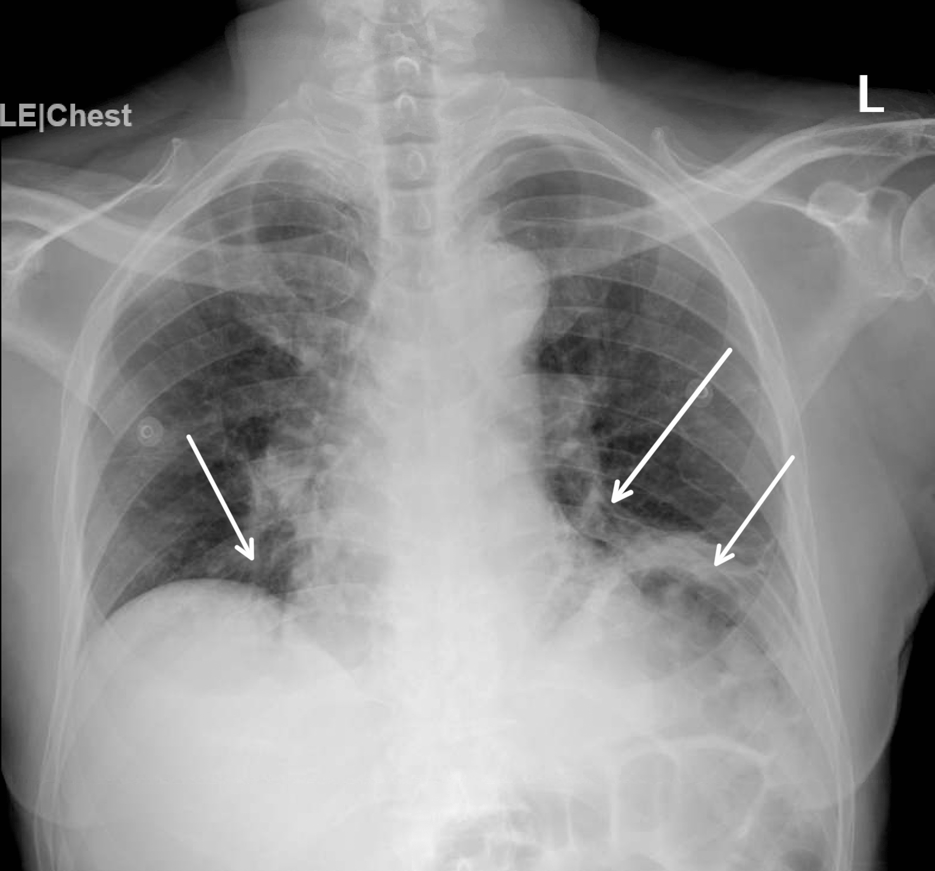 Cureus | False-Positive Human Immunodeficiency Virus Results in COVID-19  Patients | Article