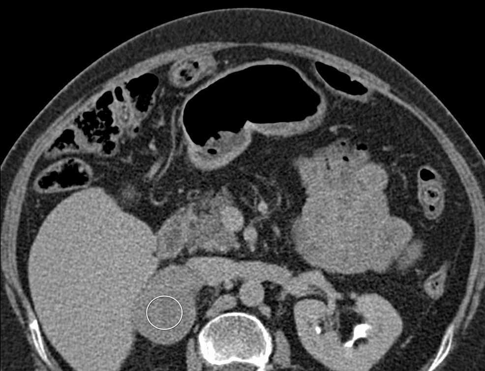 Computed-tomography-(CT)-scan-of-the-abdomen-demonstrating-incidentally-noted-adrenal-mass.