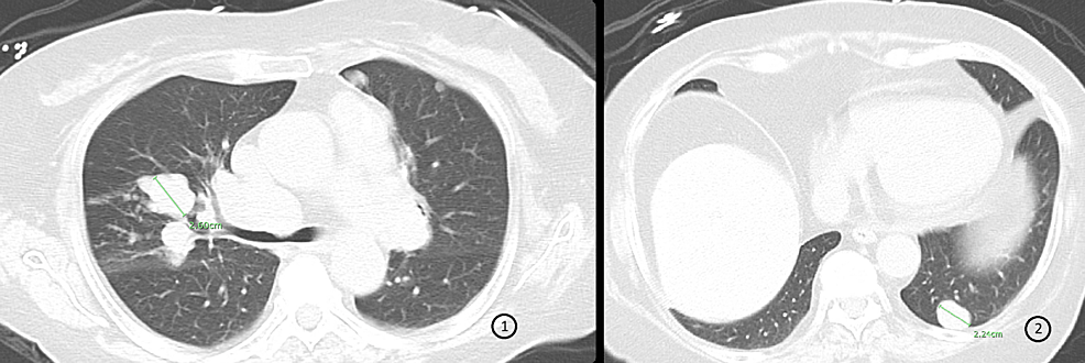 CT-of-the-chest-demonstrating-multiple-nodules-in-the-lungs-consistent-with-metastatic-disease-progression.