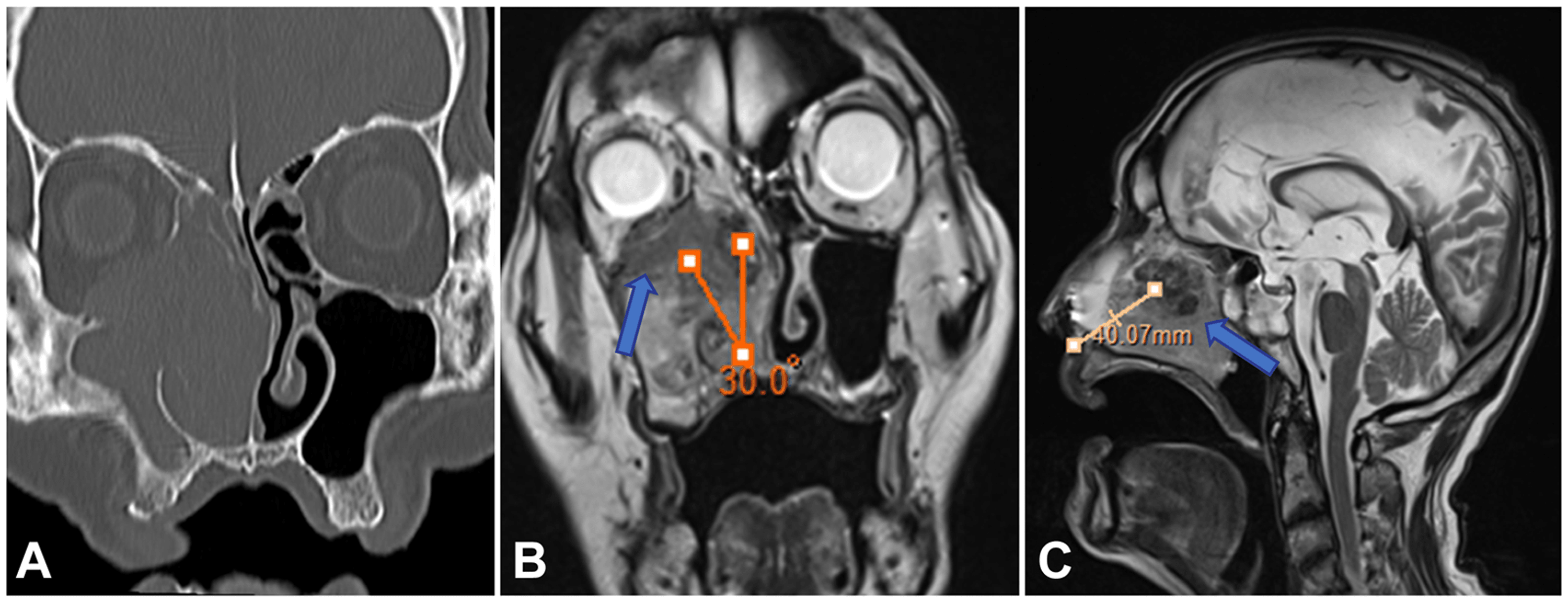 A Report of Two Cases of Malignant Tumor of the Maxillary Sinus