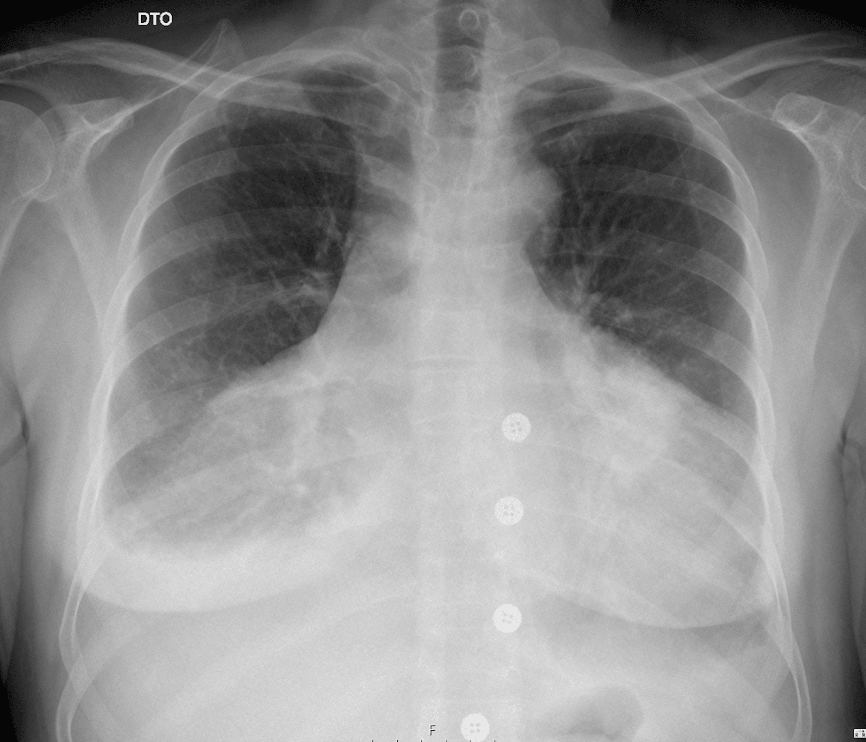 Pericarditis Chest X Ray