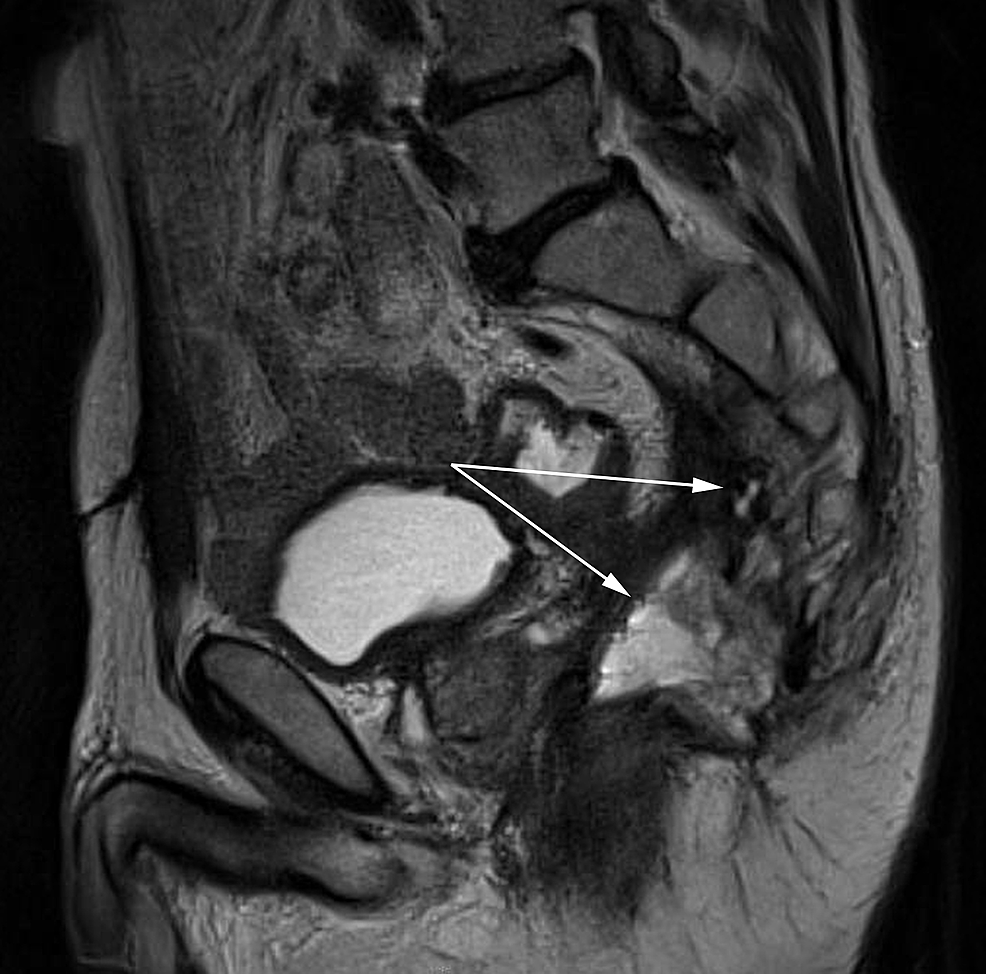 Cureus | Anastomotic Breakdown Five Years After Neoadjuvant ...