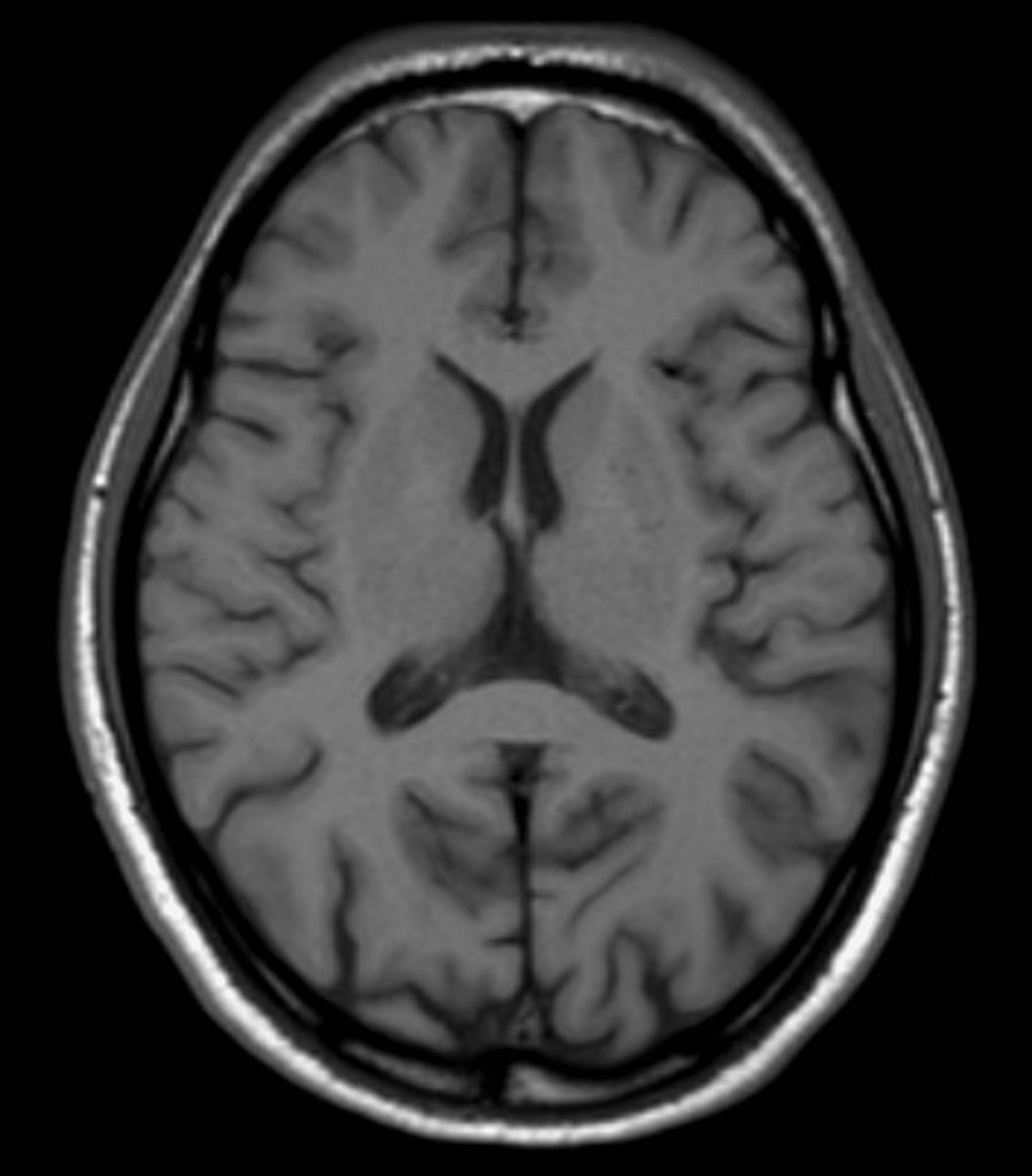 What Is Seronegative Autoimmune Encephalitis