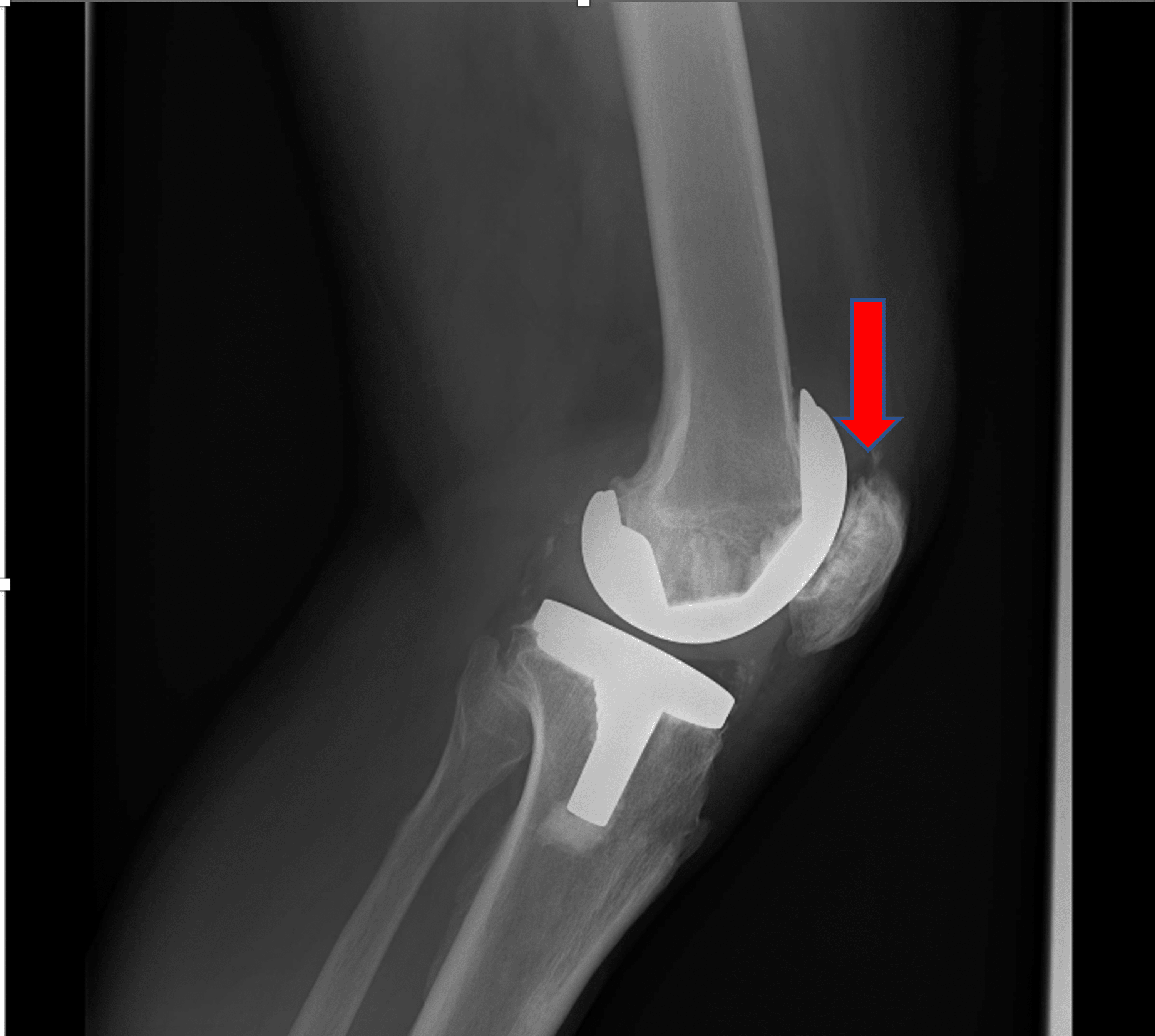 A Rare Presentation of Patella Button Aseptic Loosening After a Total
