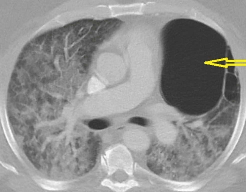 cureus-guselkumab-associated-pulmonary-disease-and-diffuse-alveolar