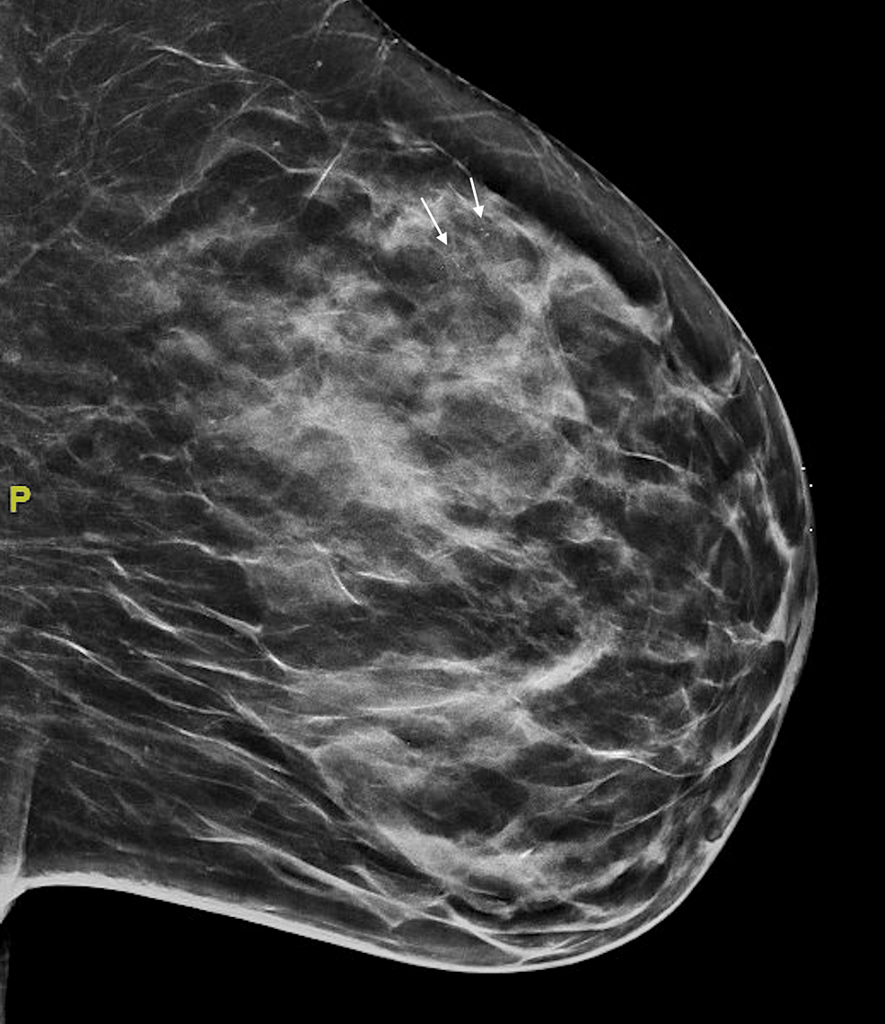 Primary Small Cell Carcinoma of the Breast: An Approach to