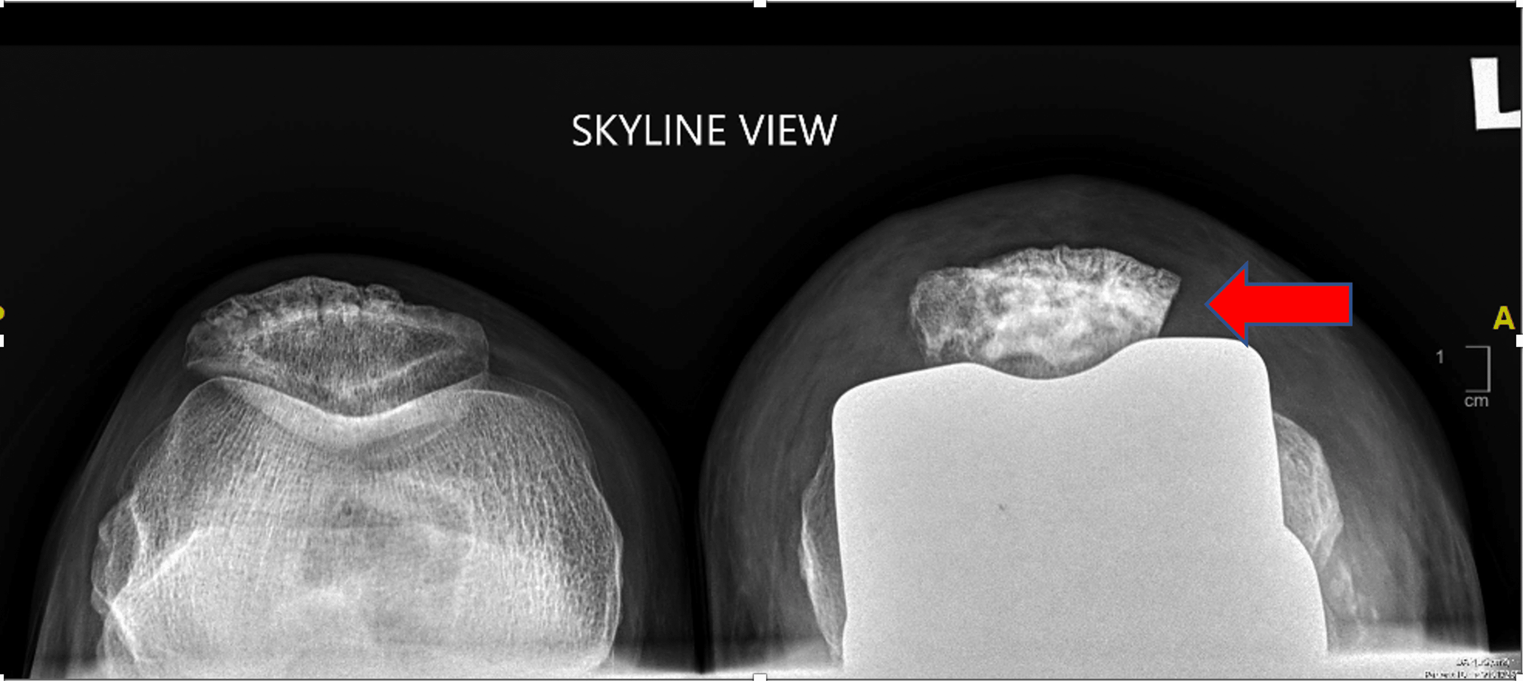 A Rare Presentation of Patella Button Aseptic Loosening After a Total