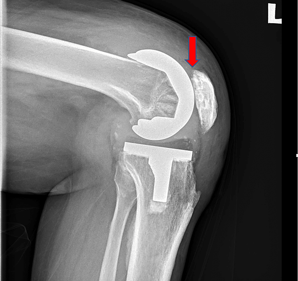 A Rare Presentation of Patella Button Aseptic Loosening After a Total