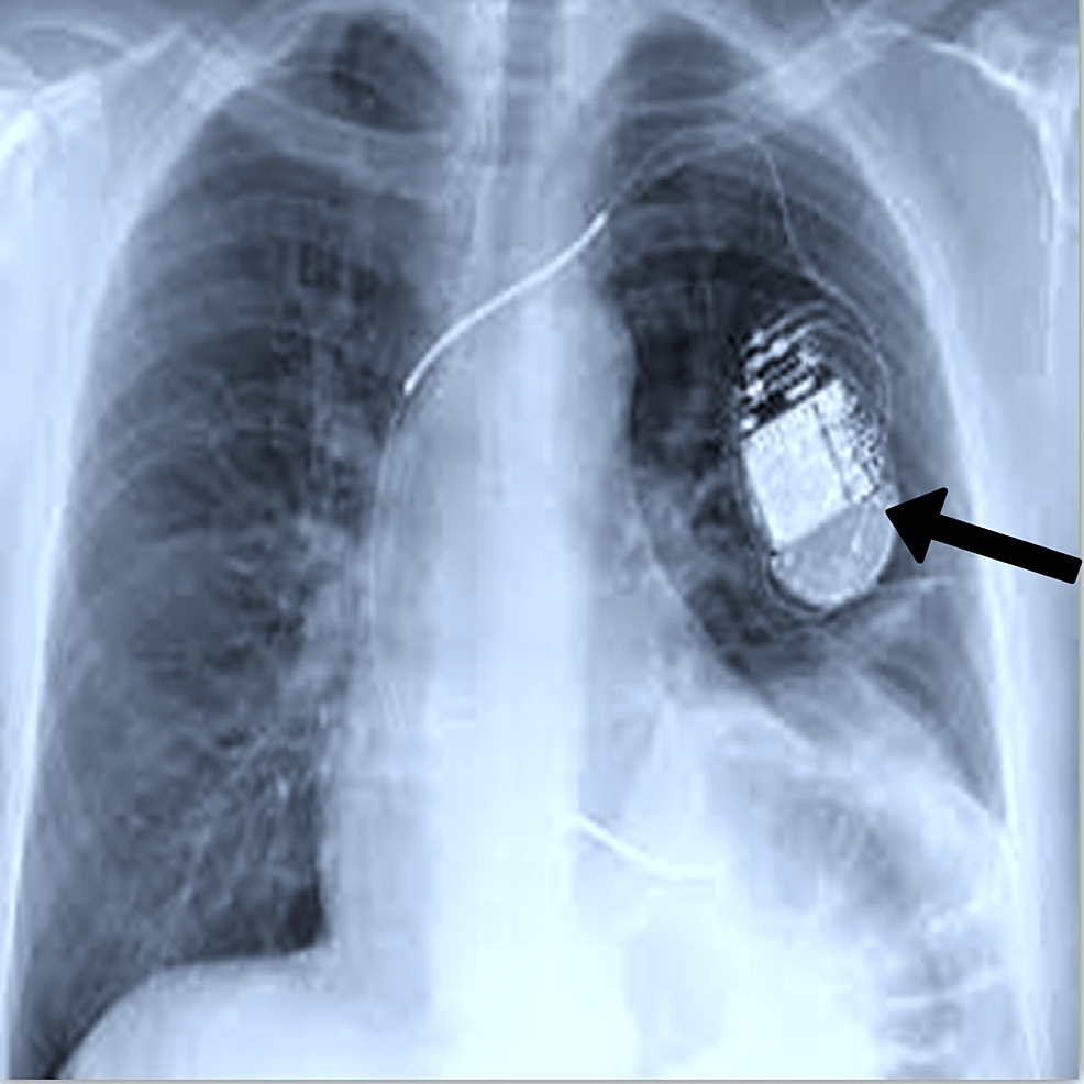 cureus-pacemaker-malfunction-in-a-patient-with-congestive-heart