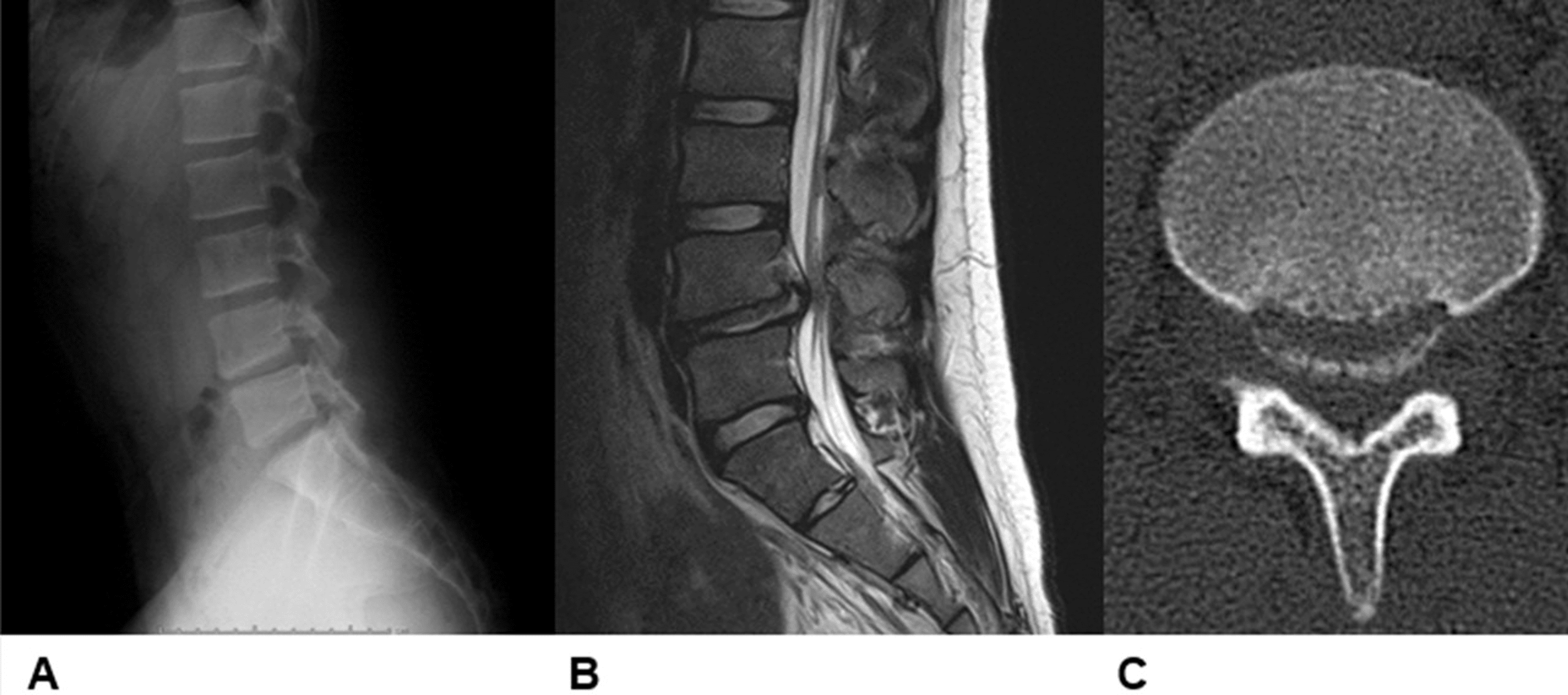 Cureus Coexistence of Lumbar Disc Herniation and Posterior Ring
