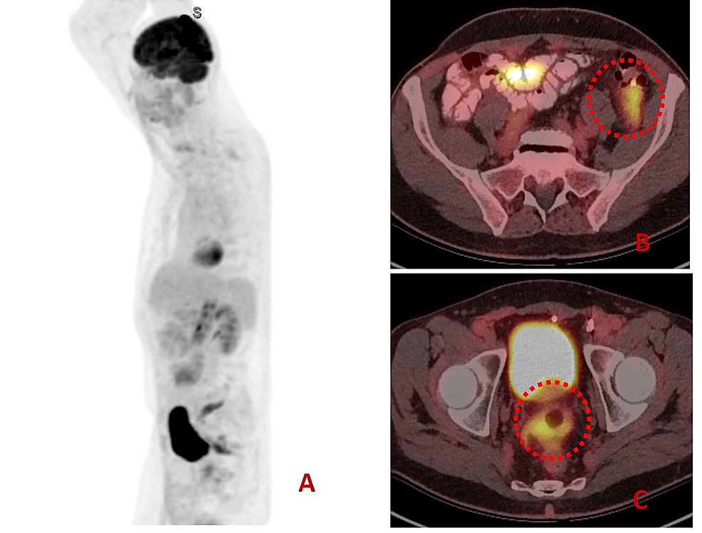peritoneal mesothelioma causes