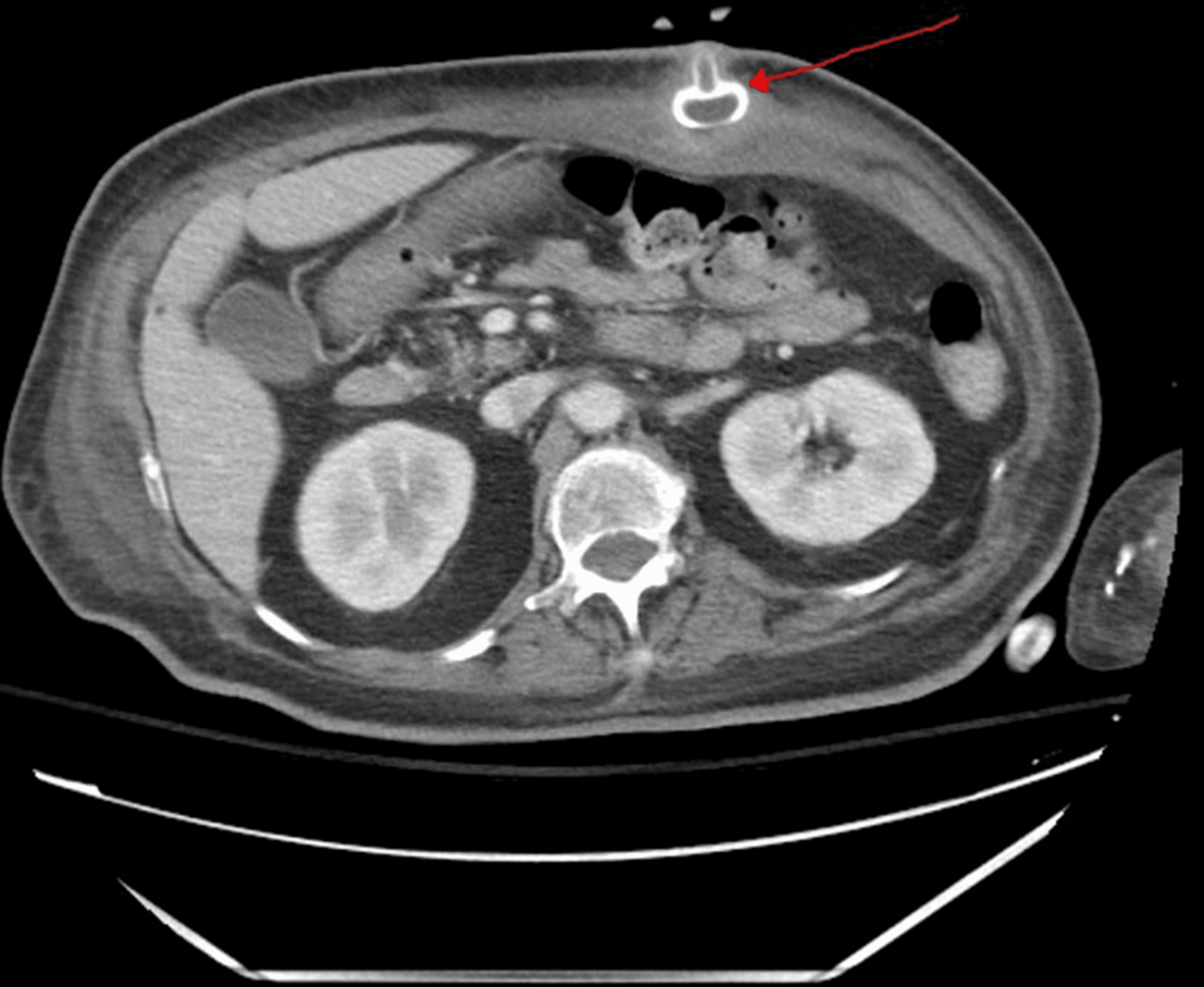 Cureus Acute Buried Bumper Syndrome A Case Report