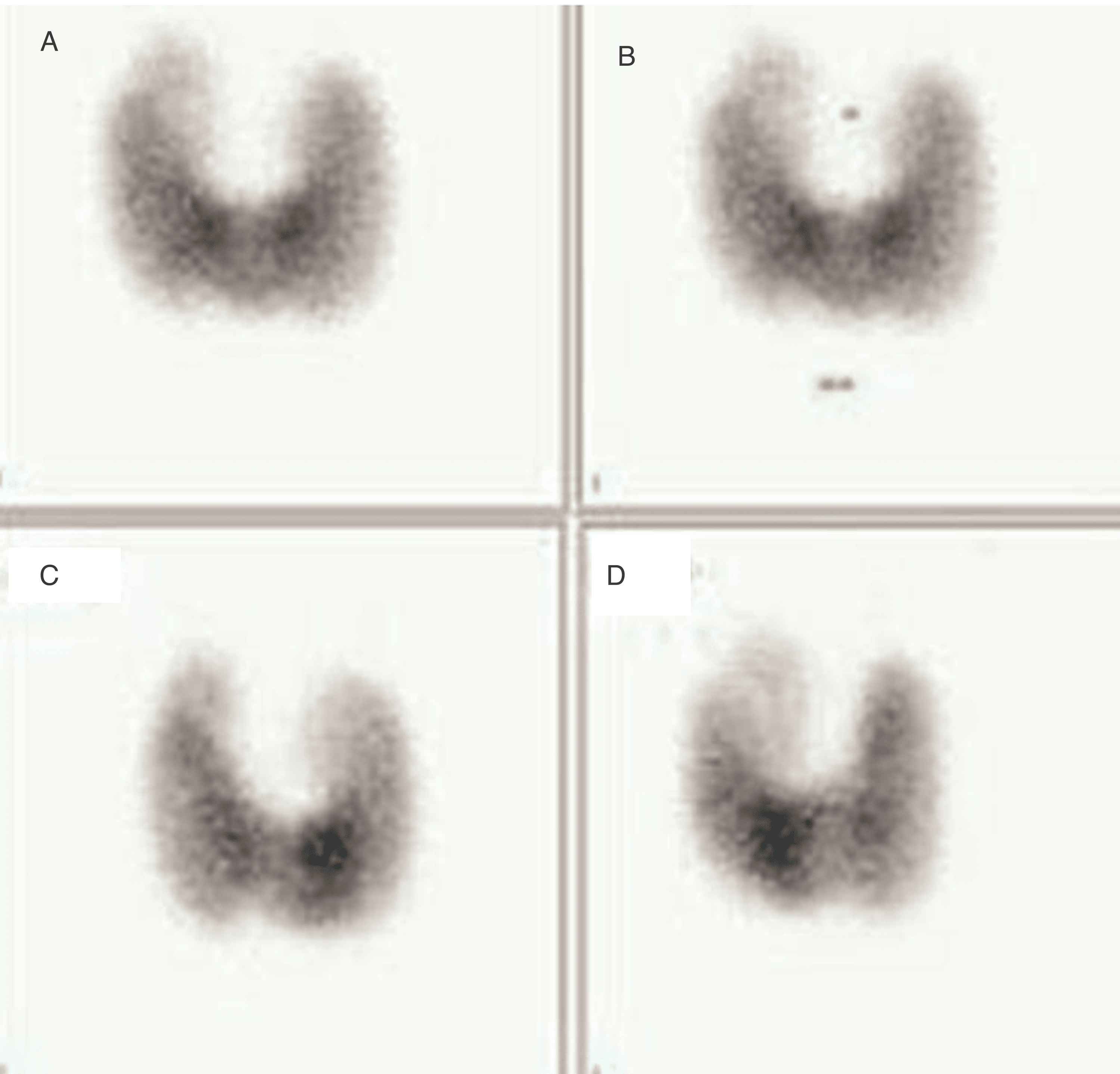 A Rare Case of PembrolizumabAssociated Graves’ Disease Cureus