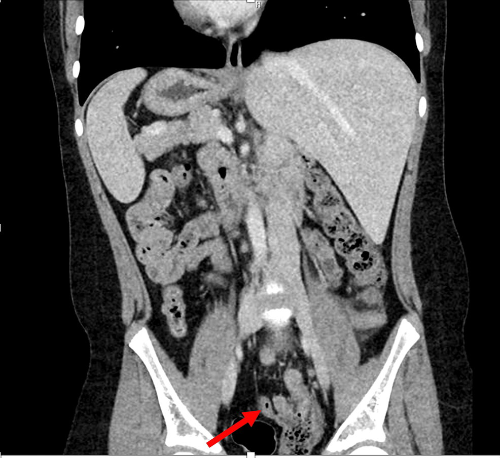 cureus-left-sided-laparoscopic-appendectomy-in-a-pediatric-patient