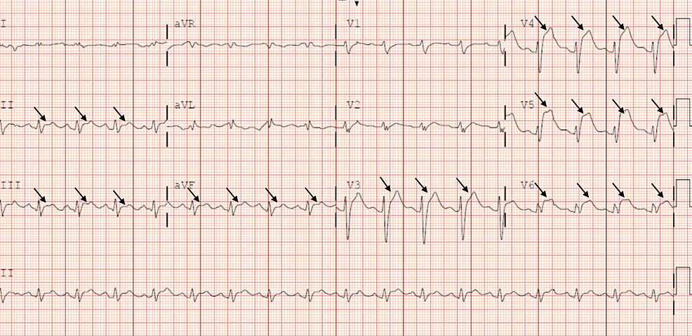 Cureus | A Perfect Storm: Ventricular Fibrillation Cardiac Arrest Due ...