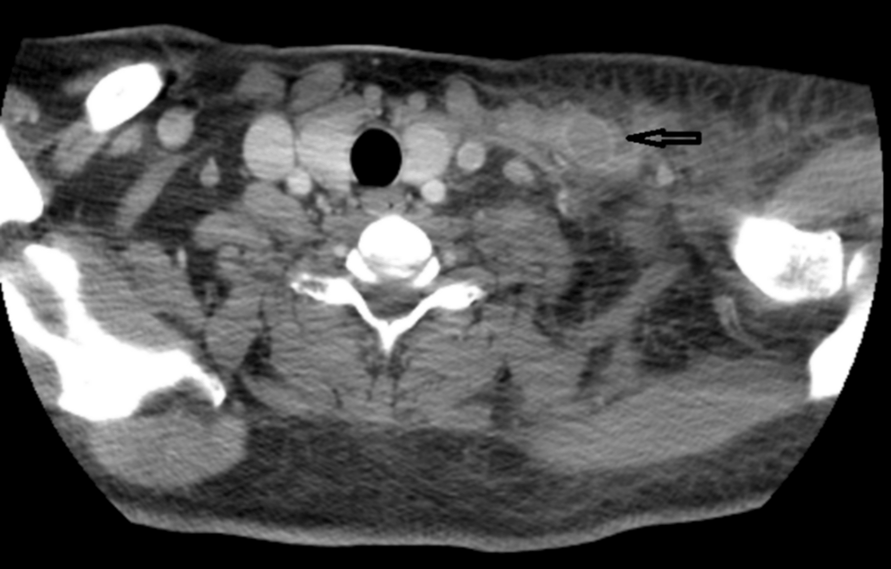 Cureus Lemierre’s Syndrome in the External Jugular Vein Precipitated