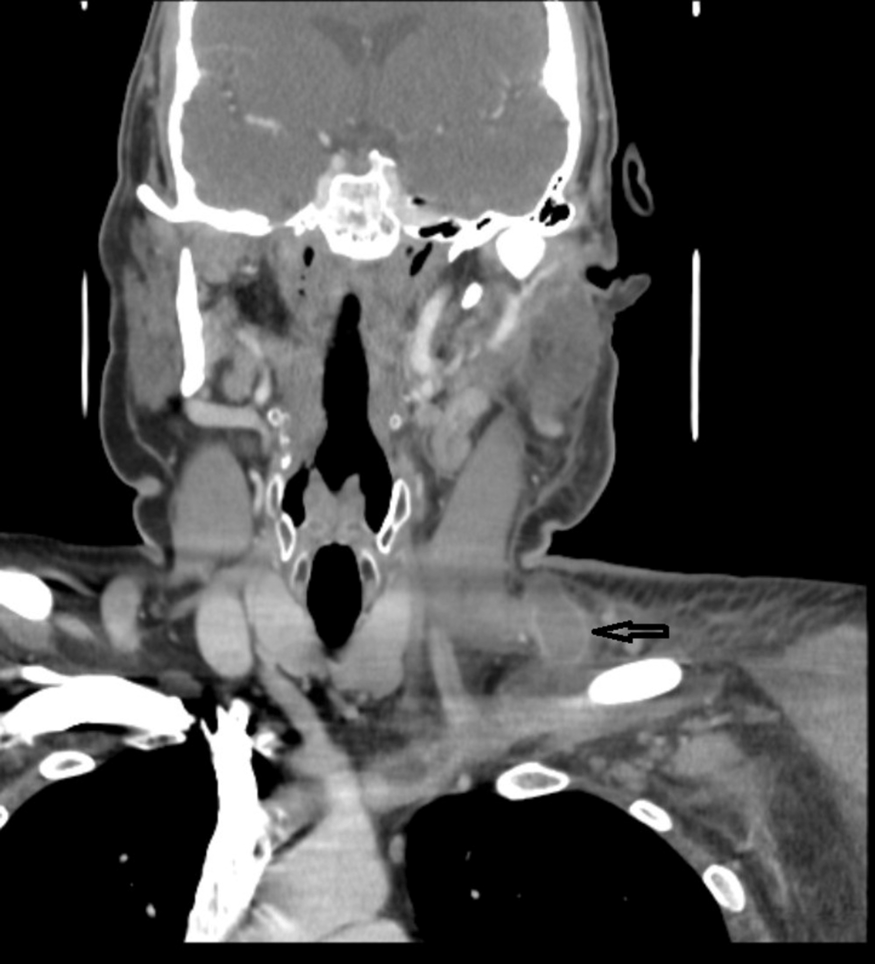 Cureus Lemierre’s Syndrome in the External Jugular Vein Precipitated