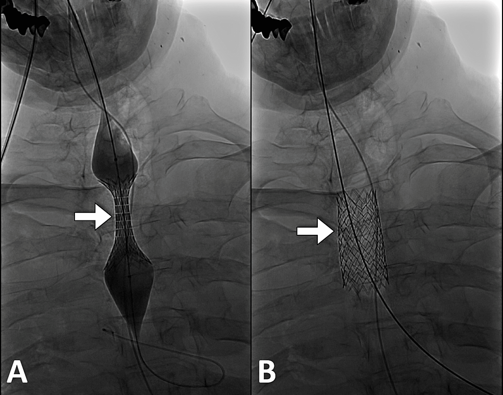 news-lyf-tracheal-stent-migration-in-a-patient-with-tracheomalacia