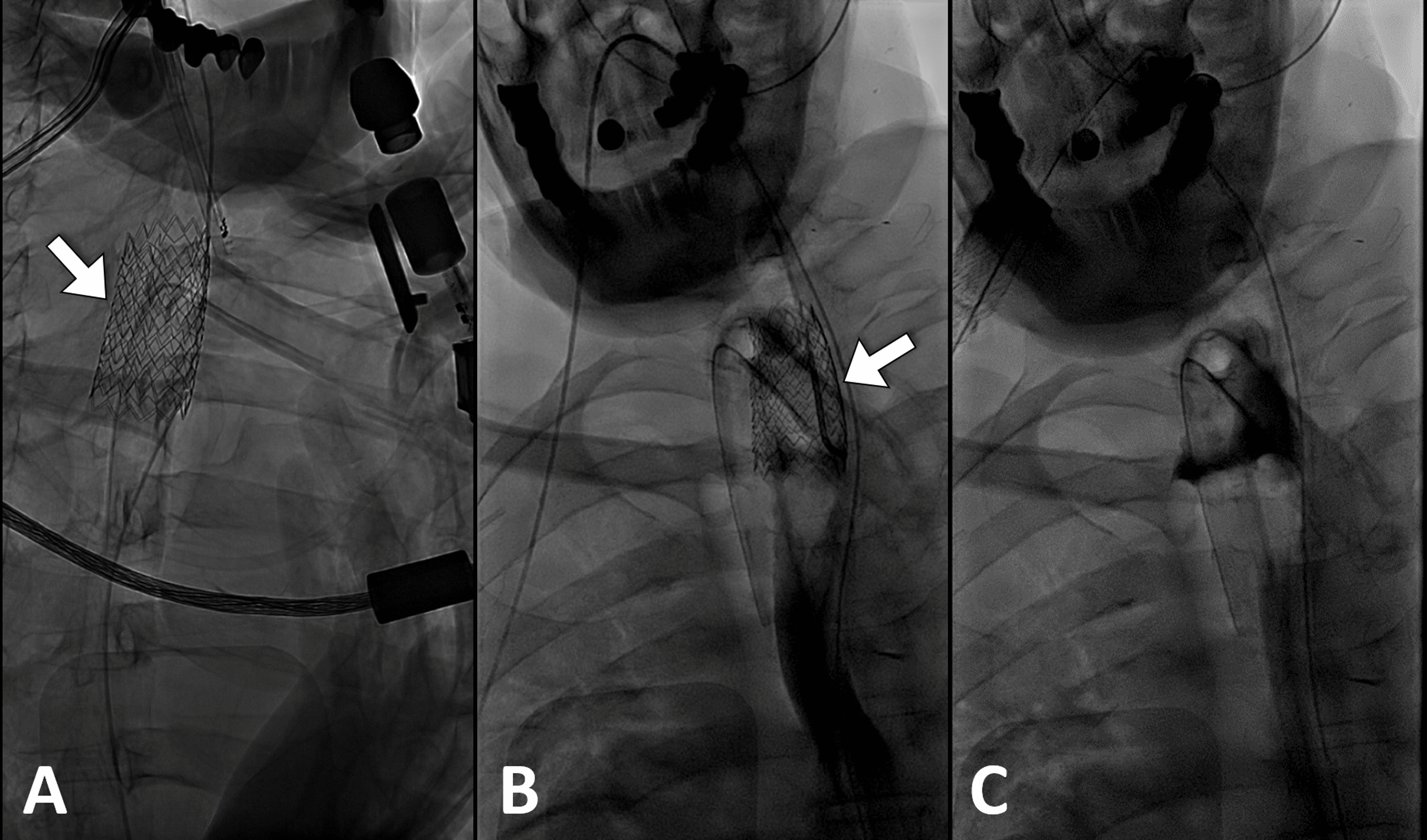 Cureus Tracheal Stent Migration in a Patient With Tracheomalacia and