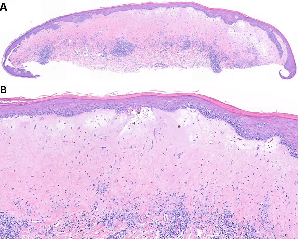 Cureus Lichen Sclerosus of the Lip