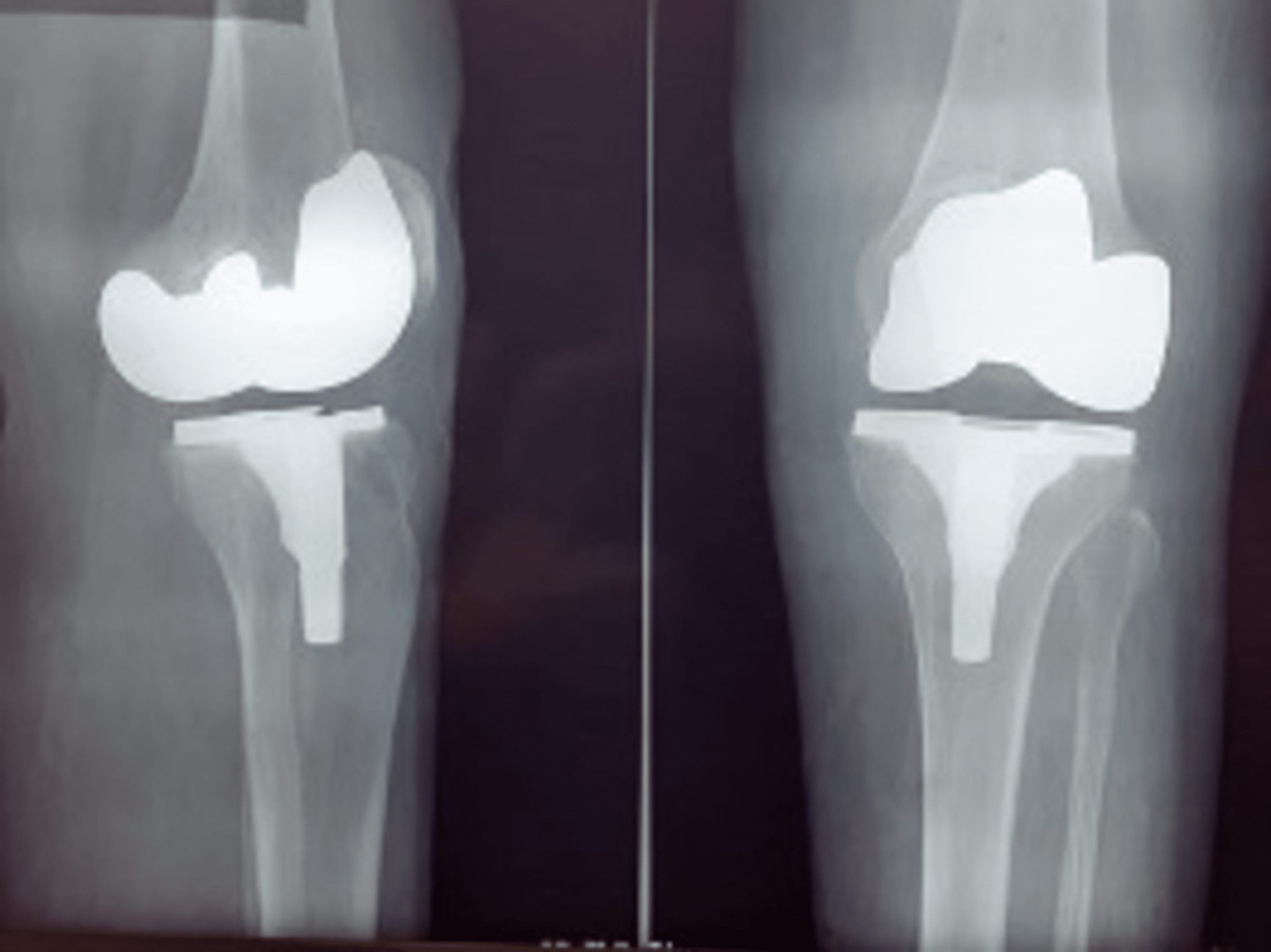 Metallosis After Oxinium Total Knee Arthroplasty In A Patient With ...