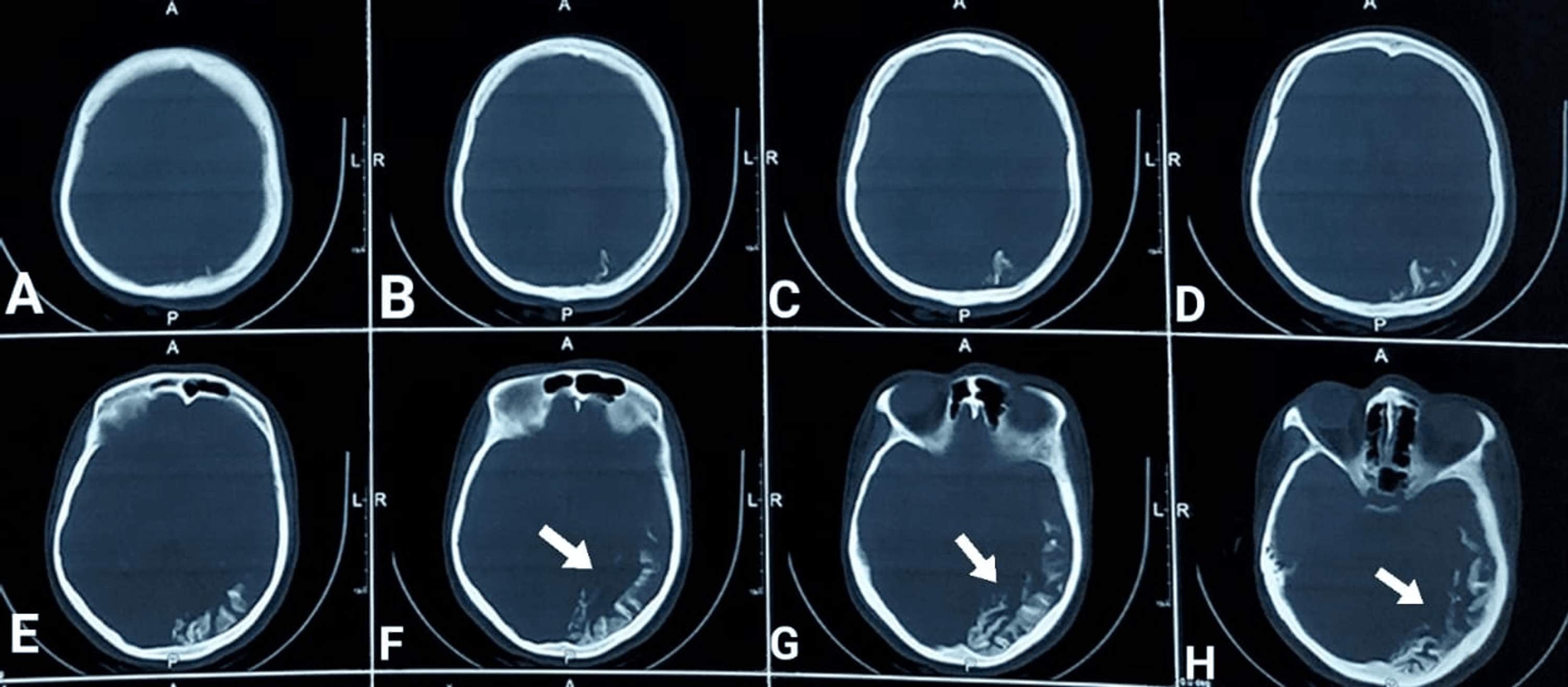 Sturge-Weber Syndrome - Neuro Case Studies - CTisus CT Scanning