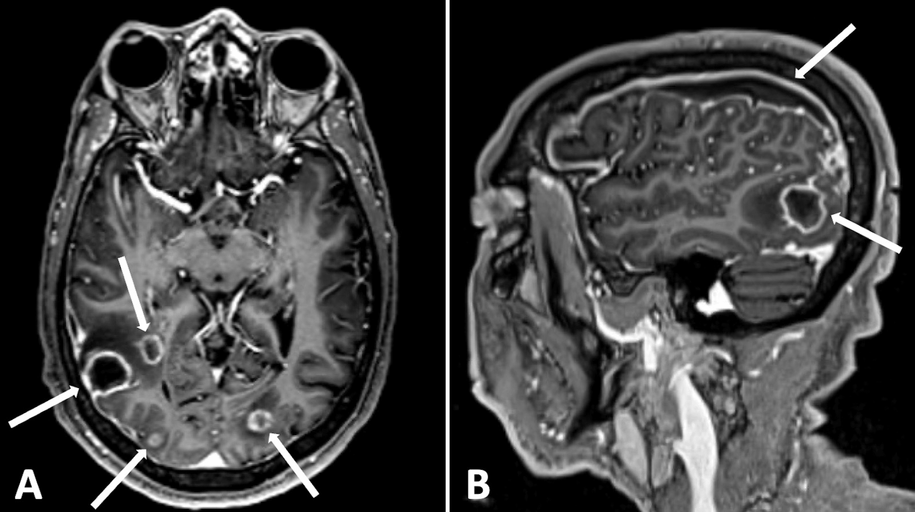 Cureus Streptococcus constellatus Brain Abscess in a MiddleAged Man
