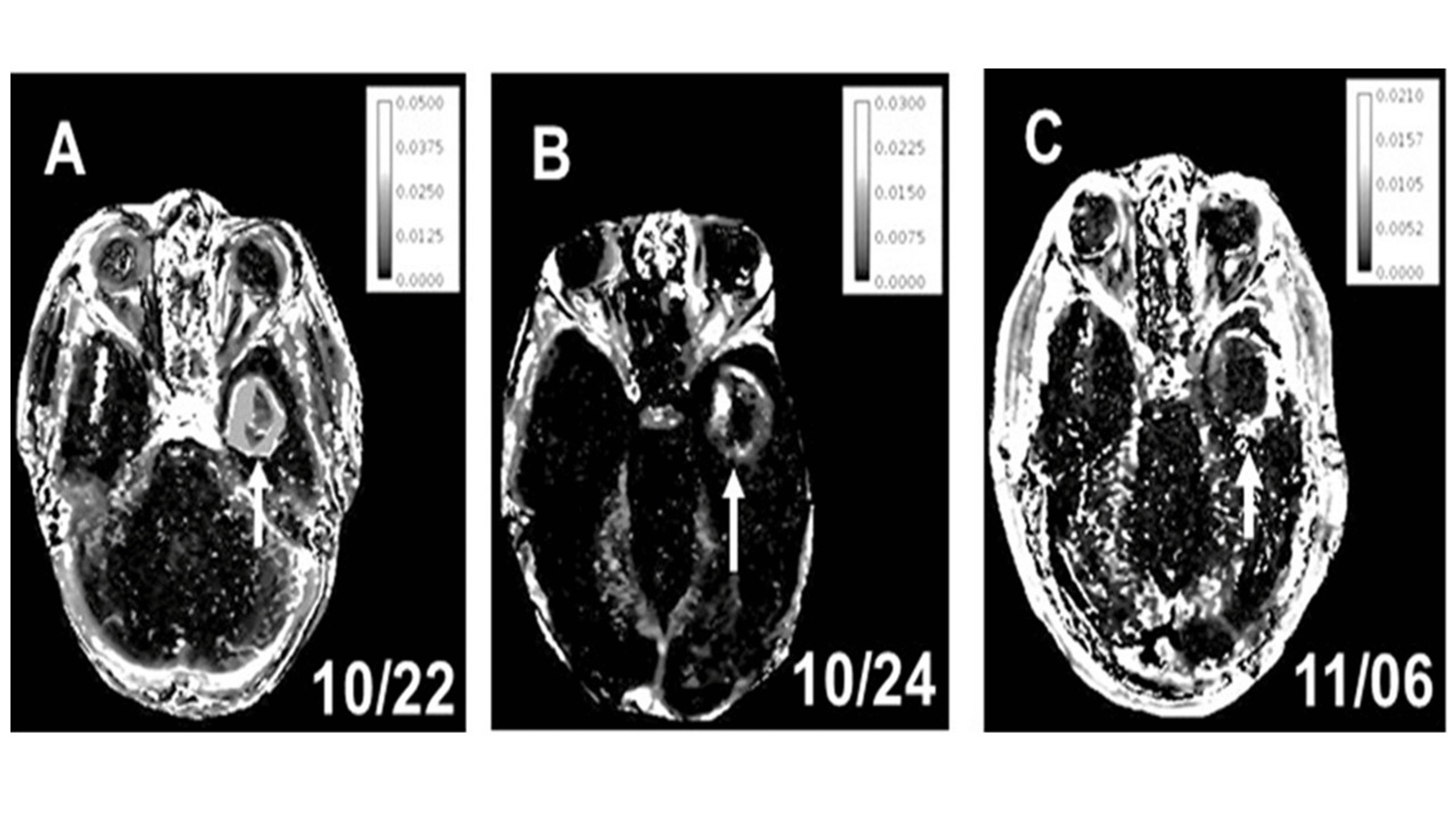 Cureus Persistent PeriAblation BloodBrain Barrier Opening After