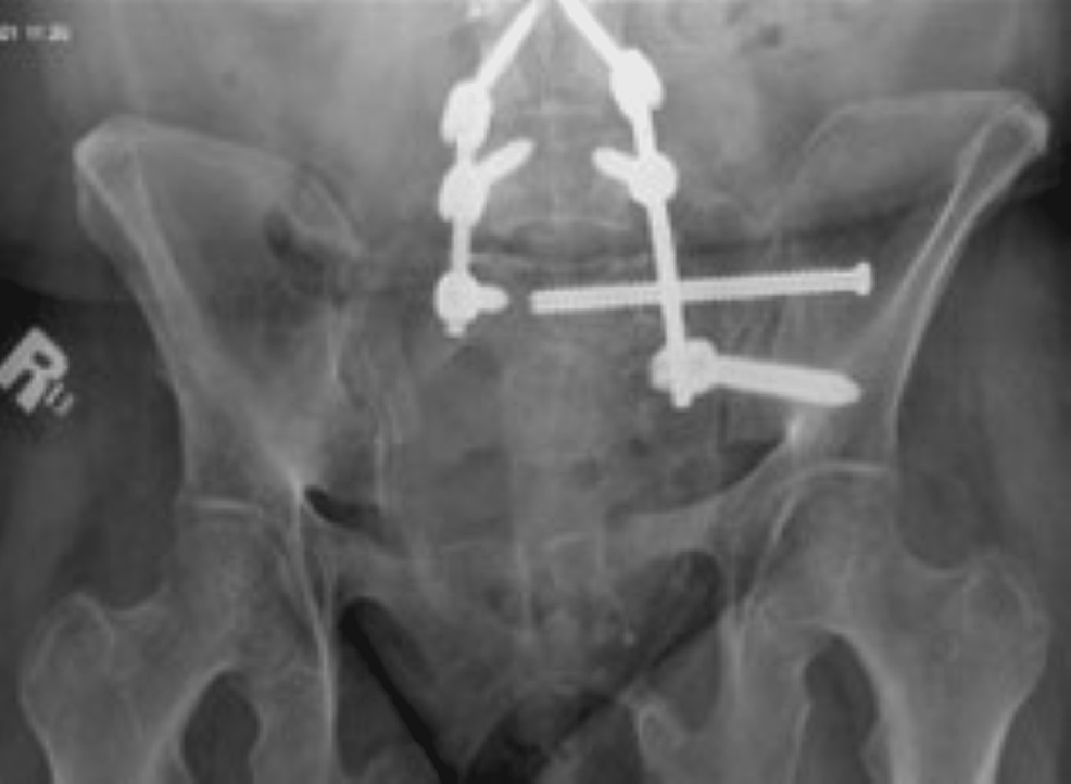 Cureus | Spinopelvic In Situ Fixation and Early Mobilization: A Case ...