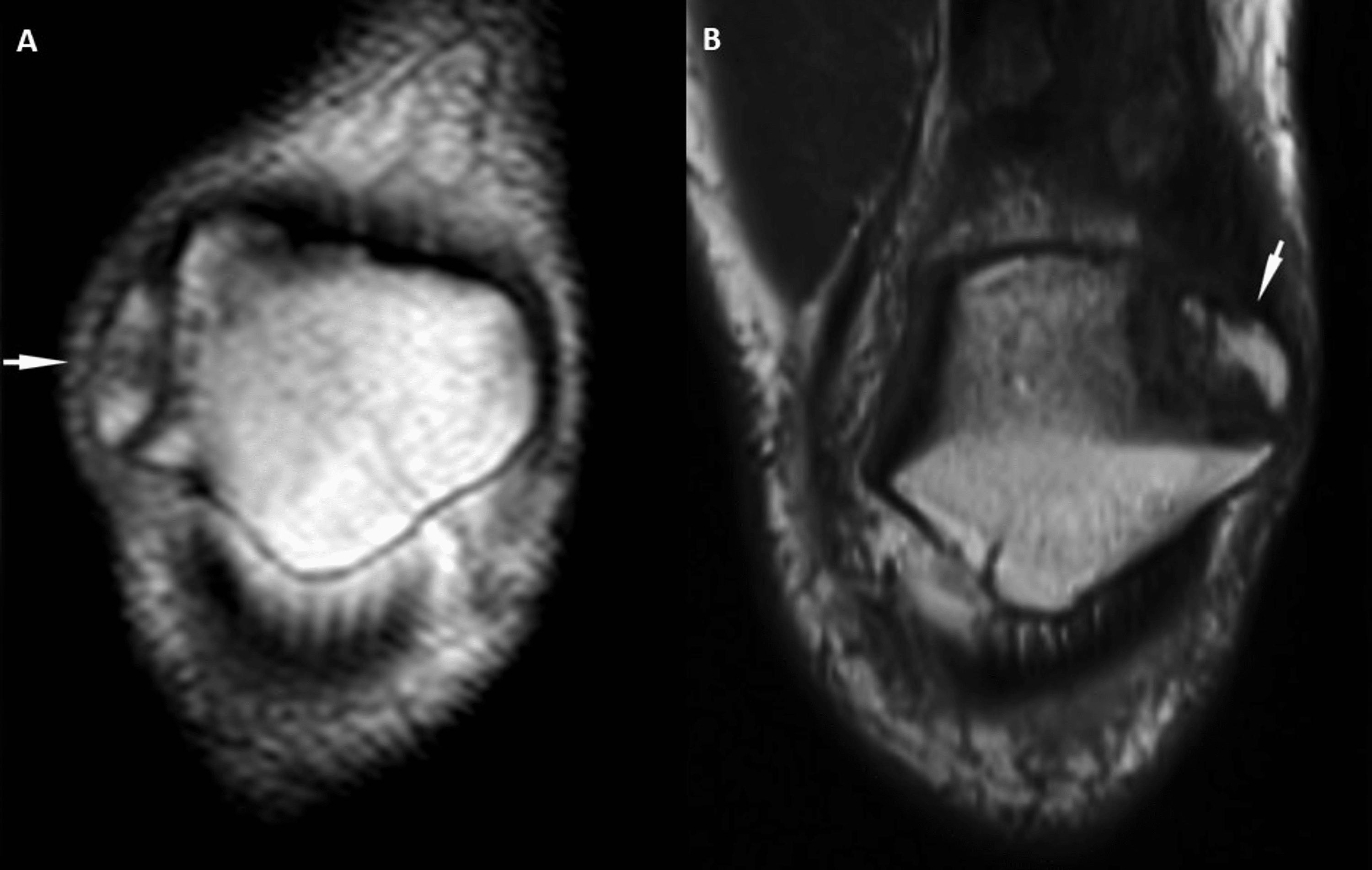 Cureus The Effect Of Patellofemoral Maltracking And Patella Type On Symptomatic Bipartite Patella