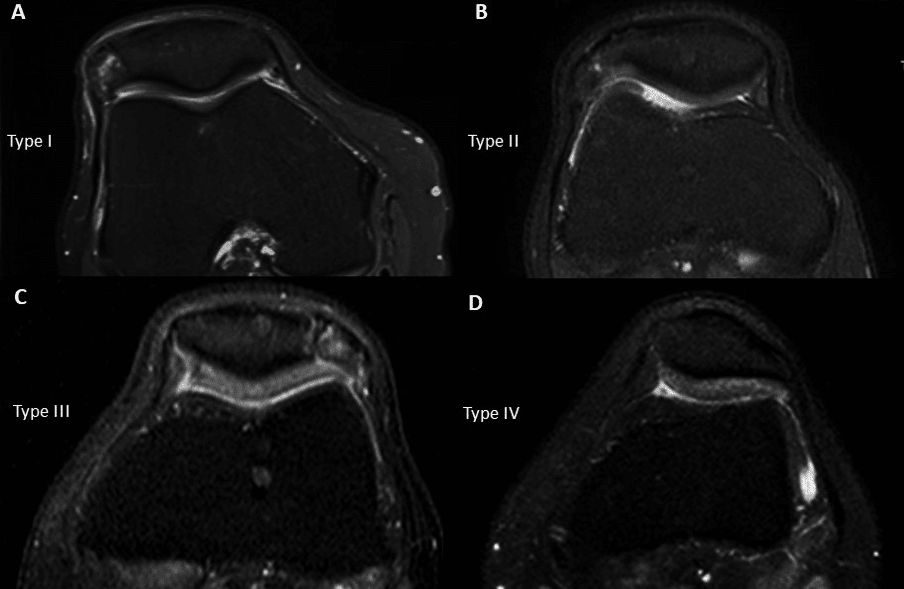 The Effect Of Patellofemoral Maltracking And Patella Type On Symptomatic Bipartite Patella Cureus