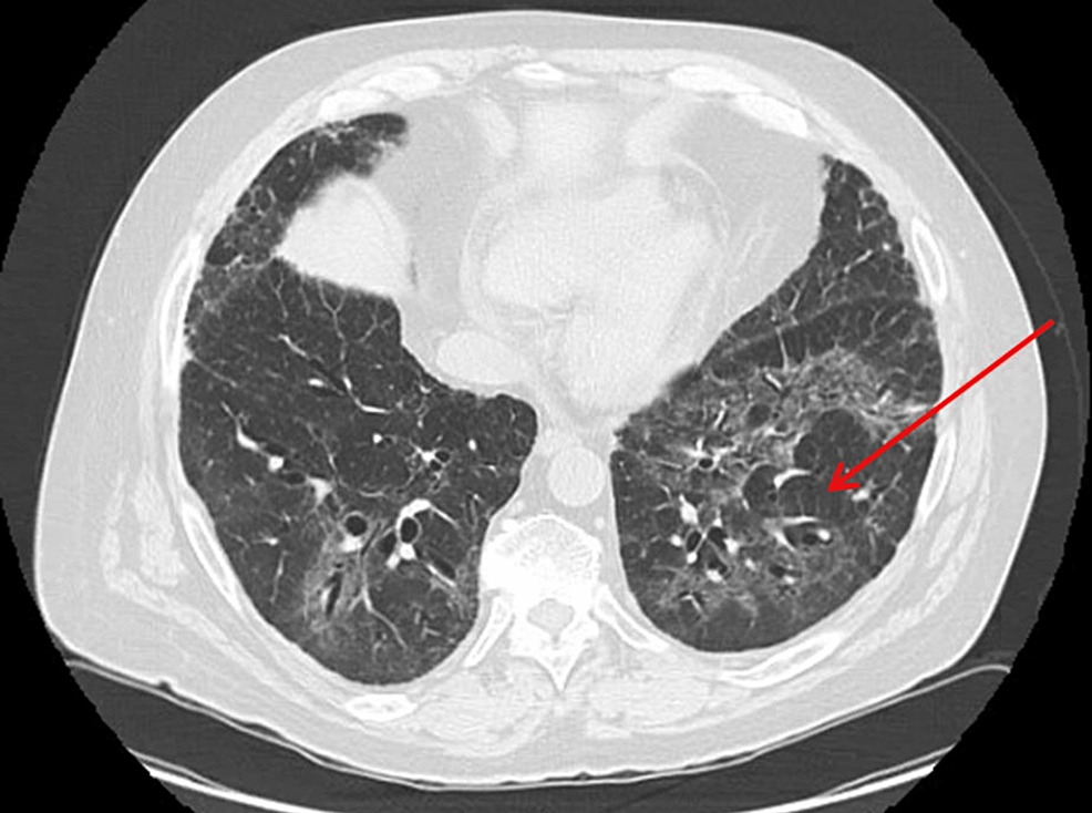 RituximabInduced Immune Dysregulation Leading to Organizing Pneumonia