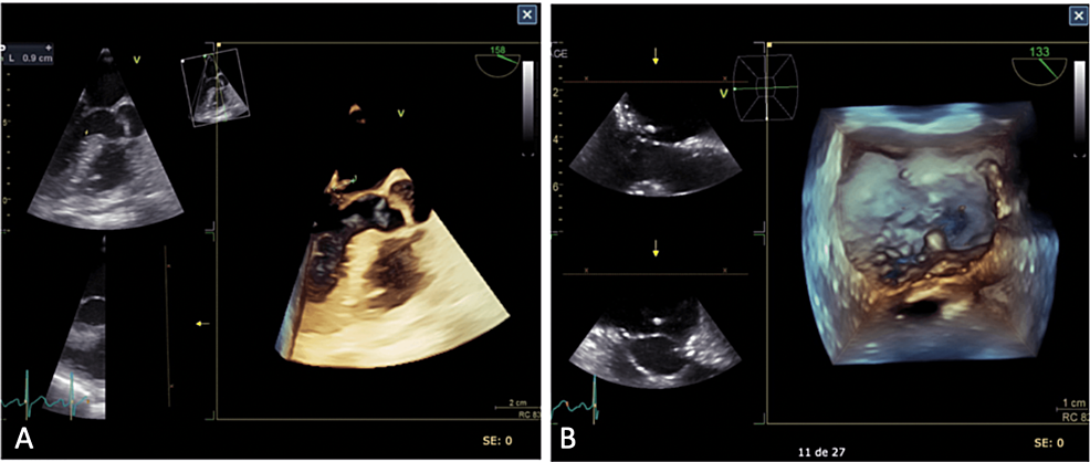 Ischemic Stroke Revealing Infective Endocarditis in a Young Subject: About  a Clinical Case